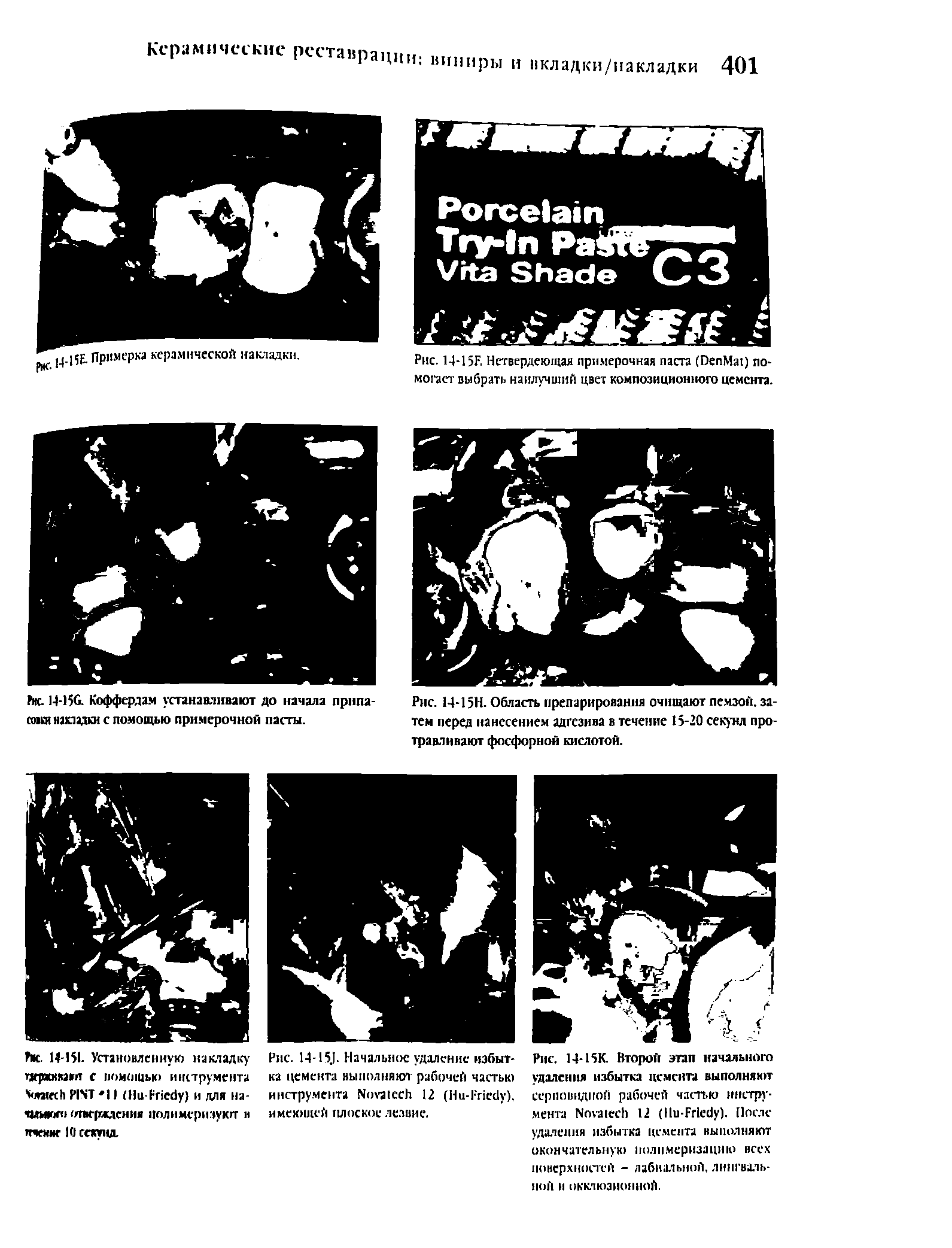 Рис. 14-15Н. Область препарирования очищают пемзой, затем перед нанесением адгезива в течение 15-20 секунд протравливают фосфорной кислотой.