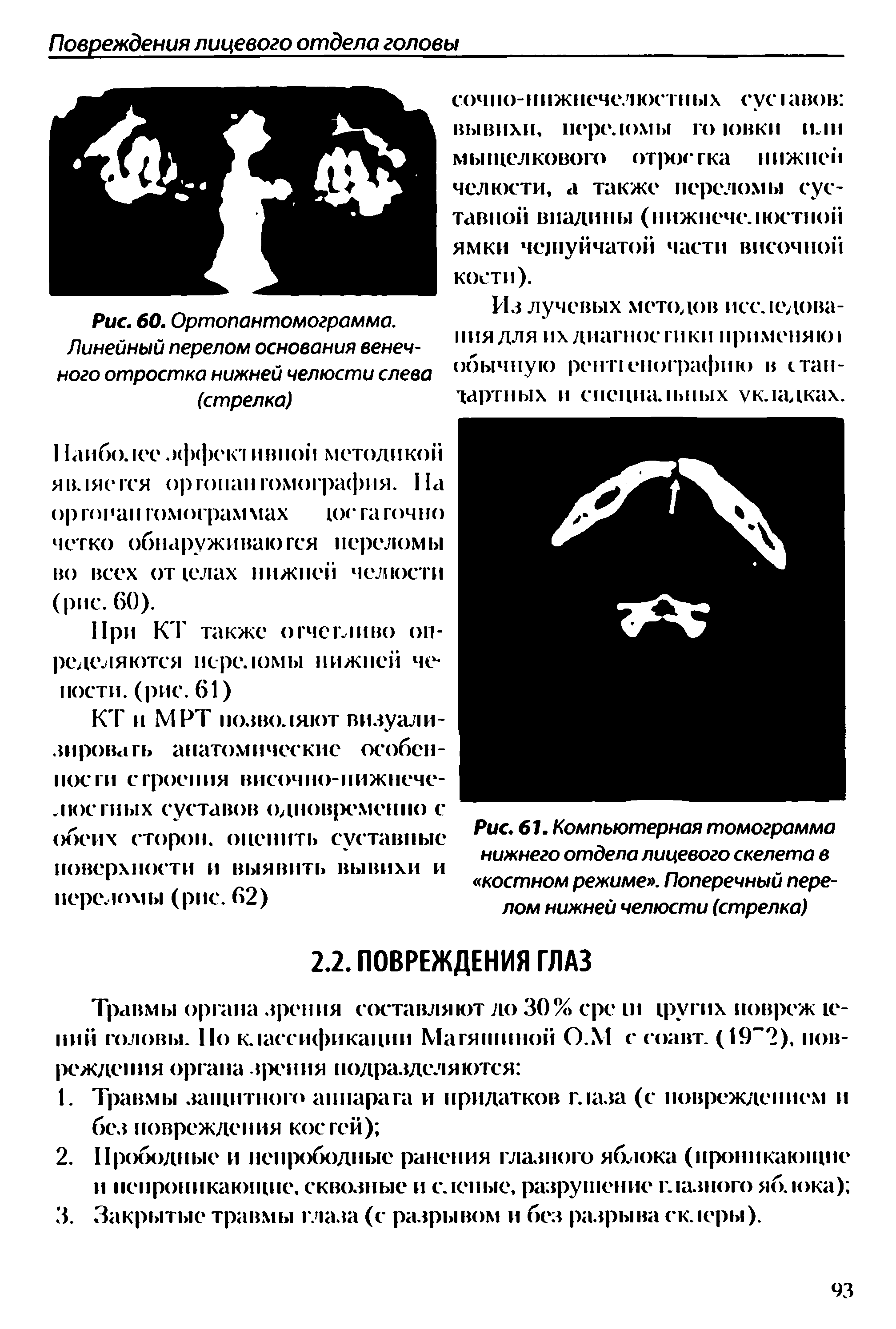 Рис. 60. Ортопантомограммо. Линейный перелом основания венечного отростка нижней челюсти слева (стрелка)...