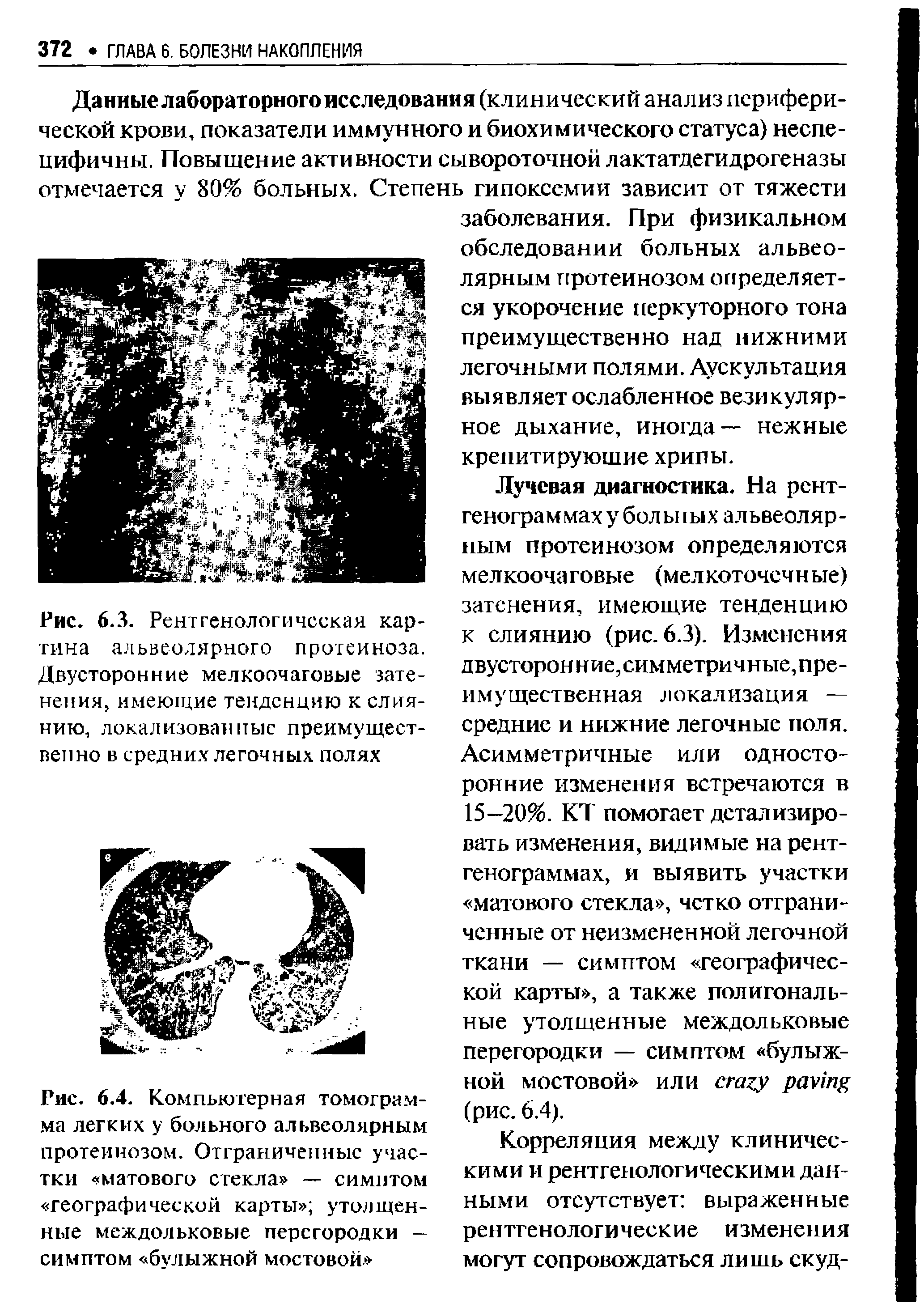 Рис. 6.4. Компьютерная томограмма легких у больного альвеолярным протеинозом. Отграниченные участки матового стекла — симптом географической карты утолщенные междольковые перегородки — симптом булыжной мостовой. ...