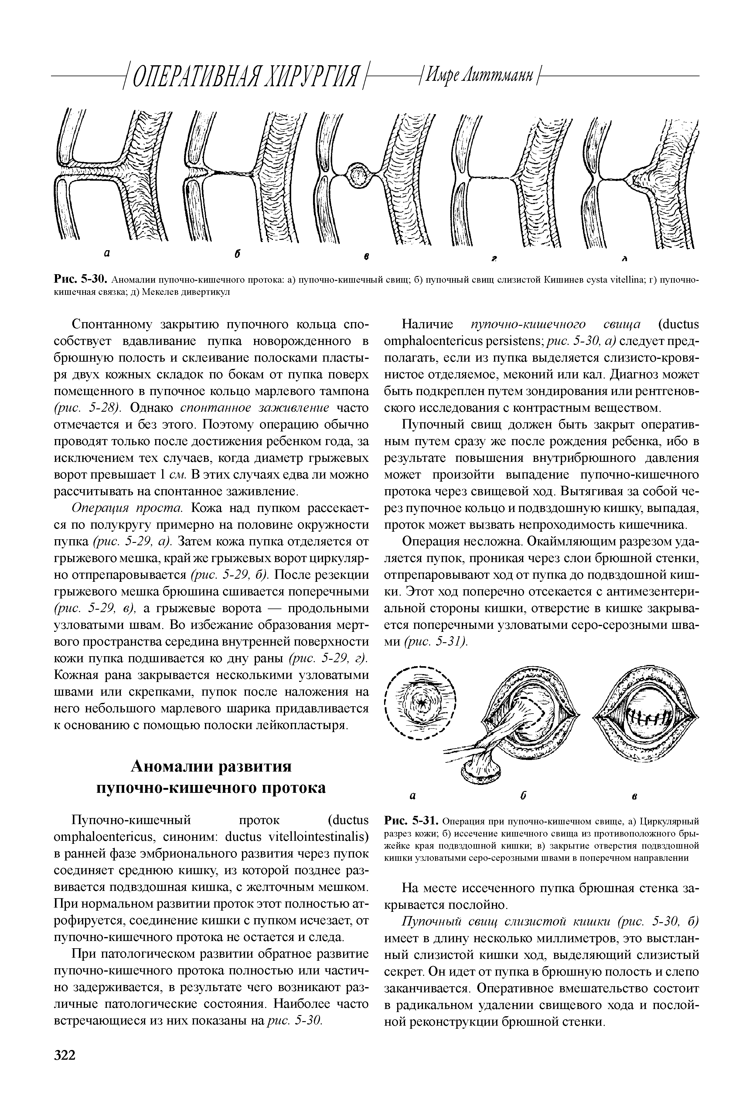 Рис. 5-31. Операция при пупочно-кишечном свище, а) Циркулярный разрез кожи б) иссечение кишечного свища из противоположного брыжейке края подвздошной кишки в) закрытие отверстия подвздошной кишки узловатыми серо-серозными швами в поперечном направлении...