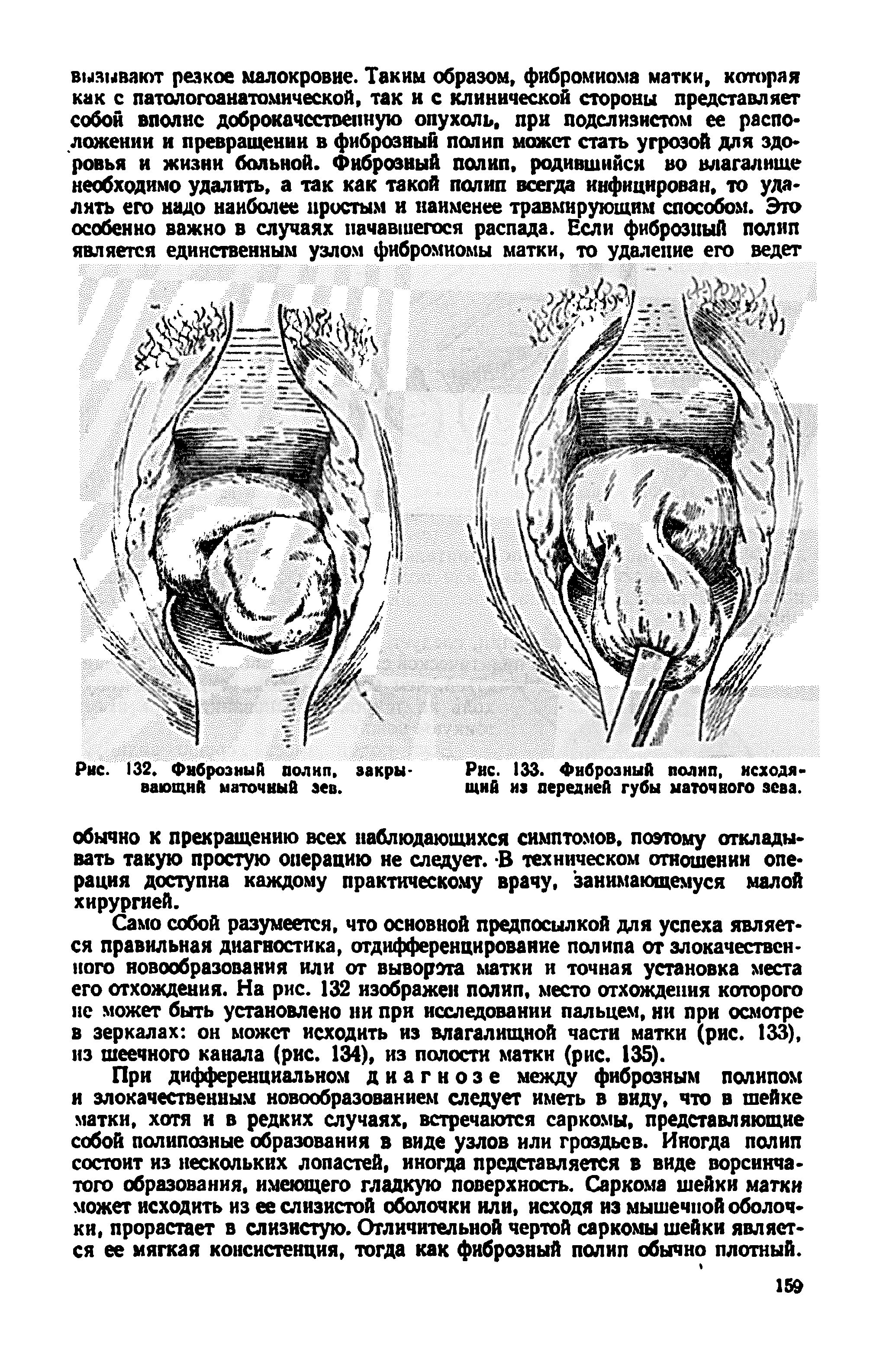 Рис. 133. Фиброзный полип, исходящий из передней губы маточного зева.