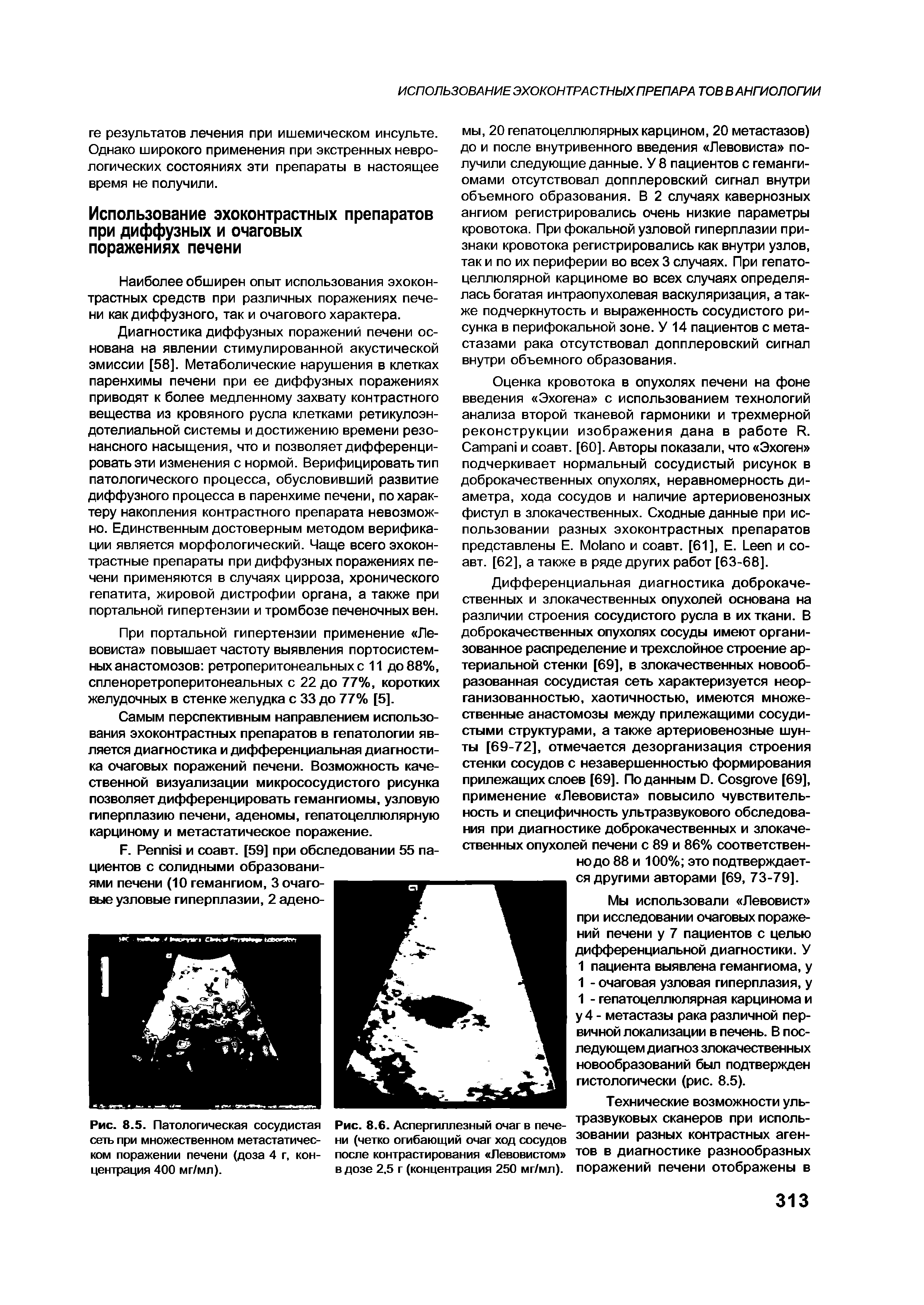 Рис. 8.6. Аспергиллезный очаг в печени (четко огибающий очаг ход сосудов после контрастирования Левовистом в дозе 2.5 г (концентрация 250 мг/мл).