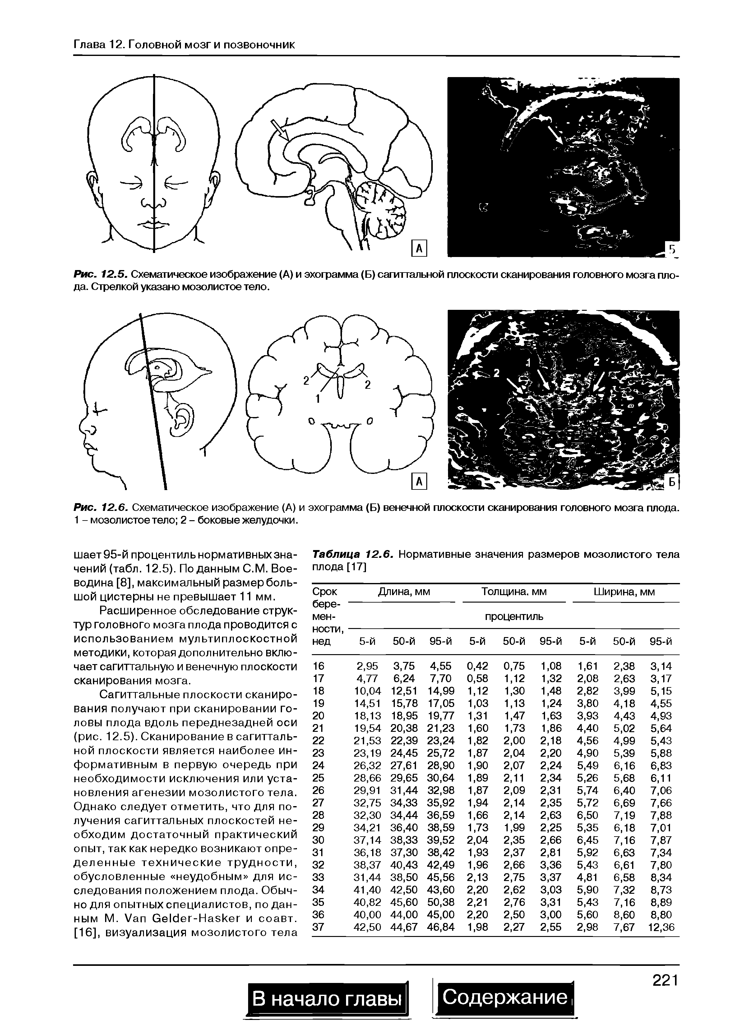 Рис. 12.6. Схематическое изображение (А) и эхограмма (Б) венечной плоскости сканирования головного мозга плода. 1 - мозолистое тело 2 - боковые желудочки.