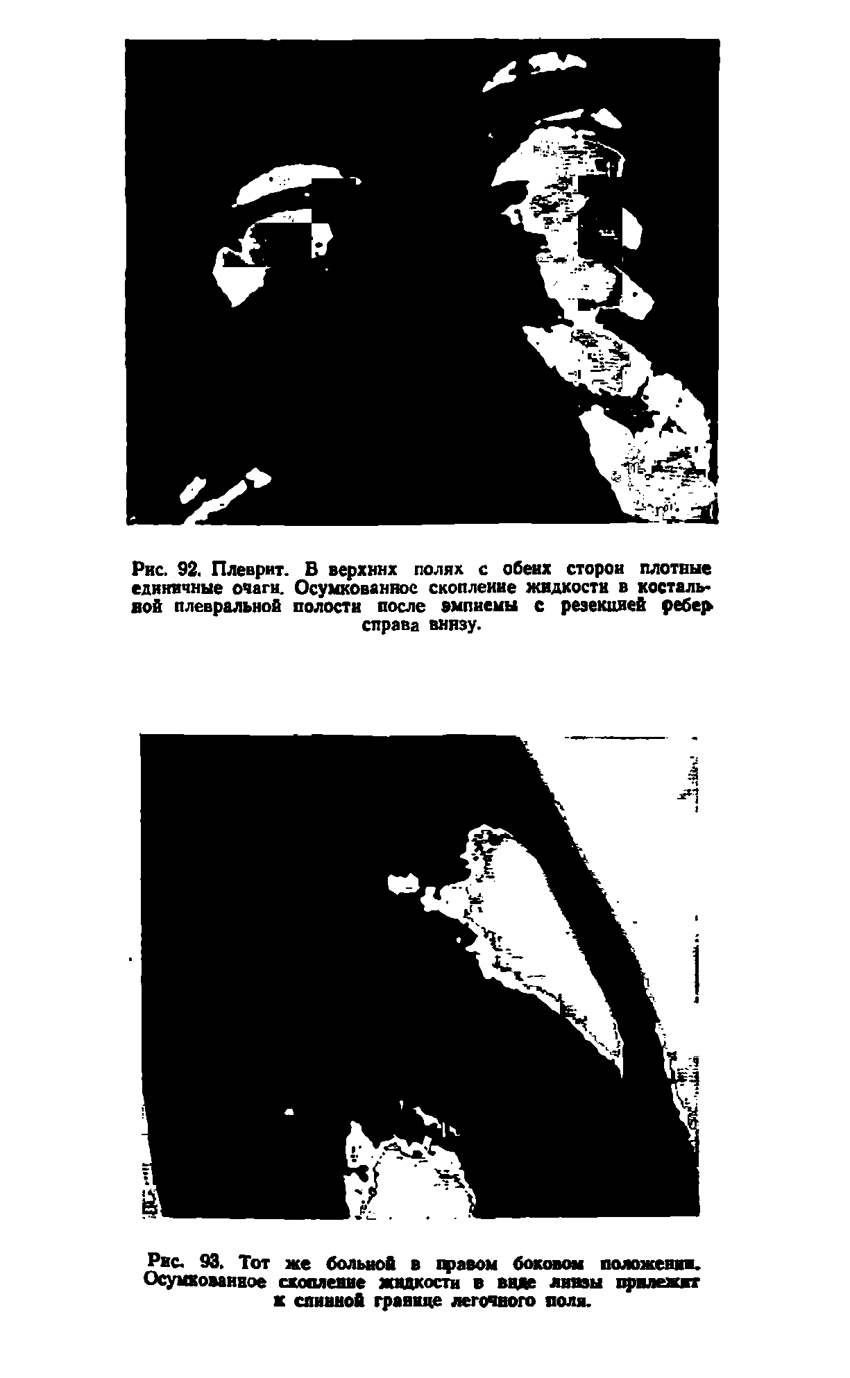 Рис. 93. Тот же больной в ц>авом боковом положении. Осумкованное скопление жидкости в виде ливзы прилежит к спинной границе легочного поля.