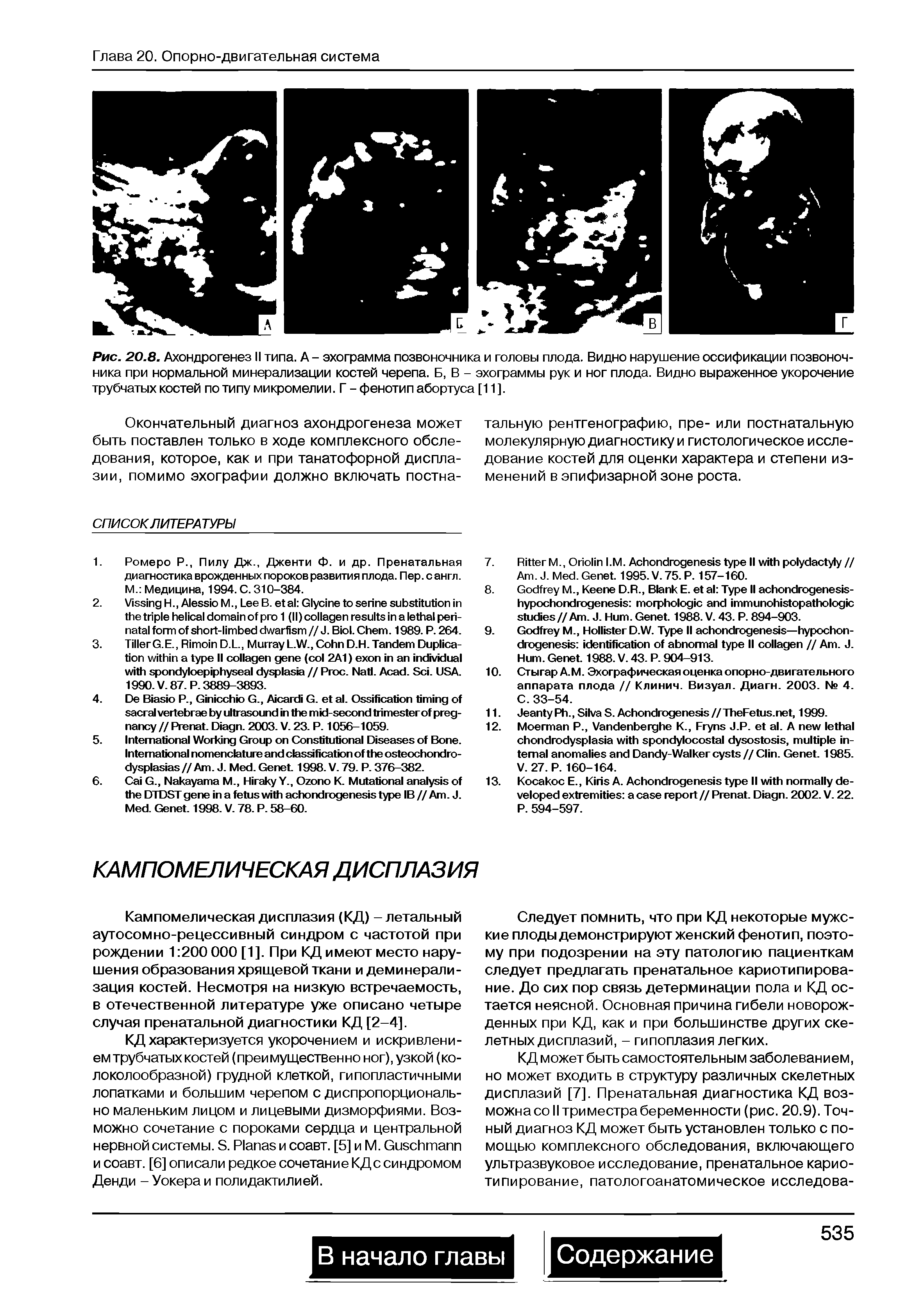 Рис. 20.8. Ахондрогенез II типа. А - эхограмма позвоночника и головы плода. Видно нарушение оссификации позвоночника при нормальной минерализации костей черепа. Б, В - эхограммы рук и ног плода. Видно выраженное укорочение трубчатых костей по типу микромелии. Г - фенотип абортуса [11].