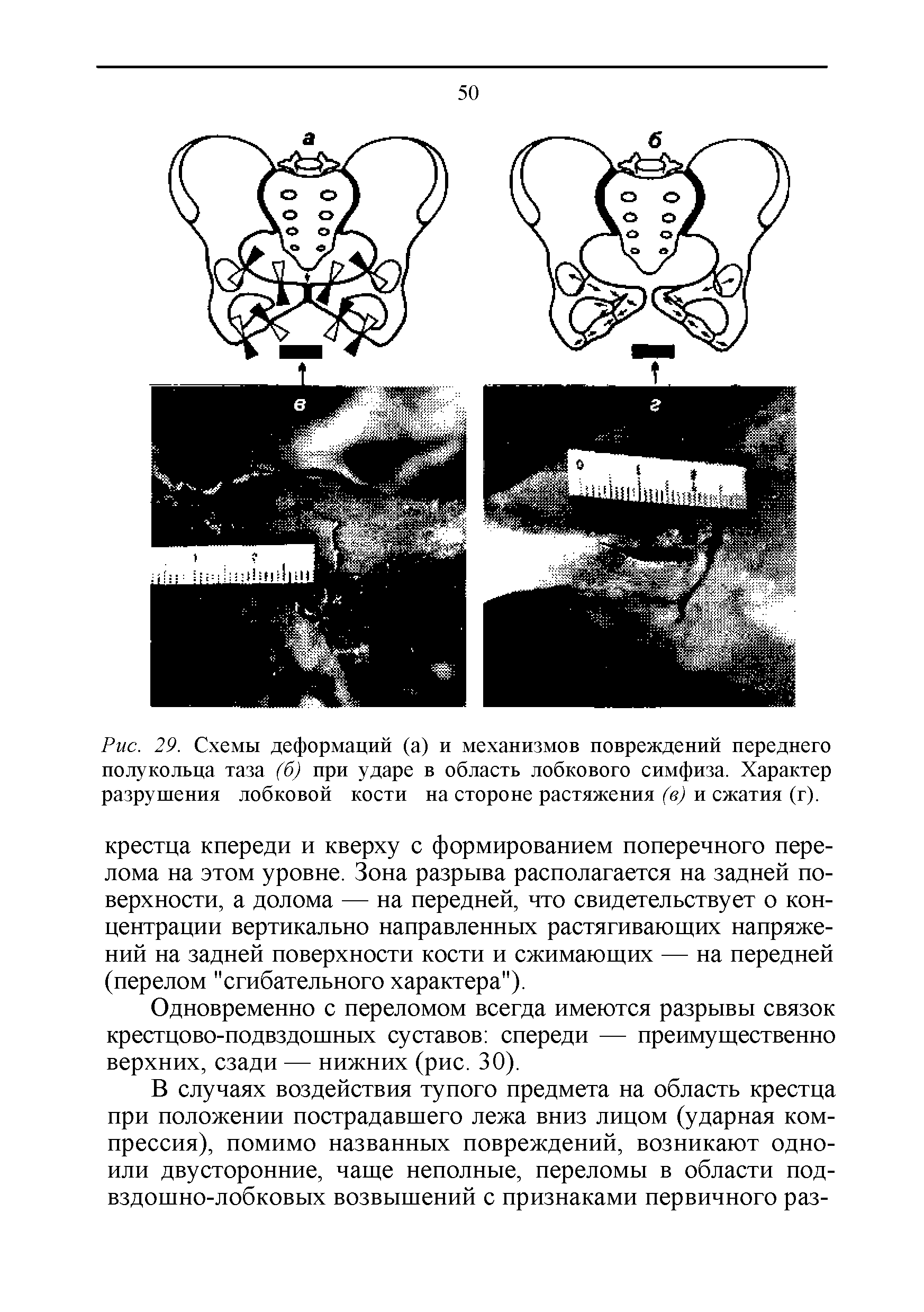 Рис. 29. Схемы деформаций (а) и механизмов повреждений переднего полукольца таза (б) при ударе в область лобкового симфиза. Характер разрушения лобковой кости на стороне растяжения (в) и сжатия (г).