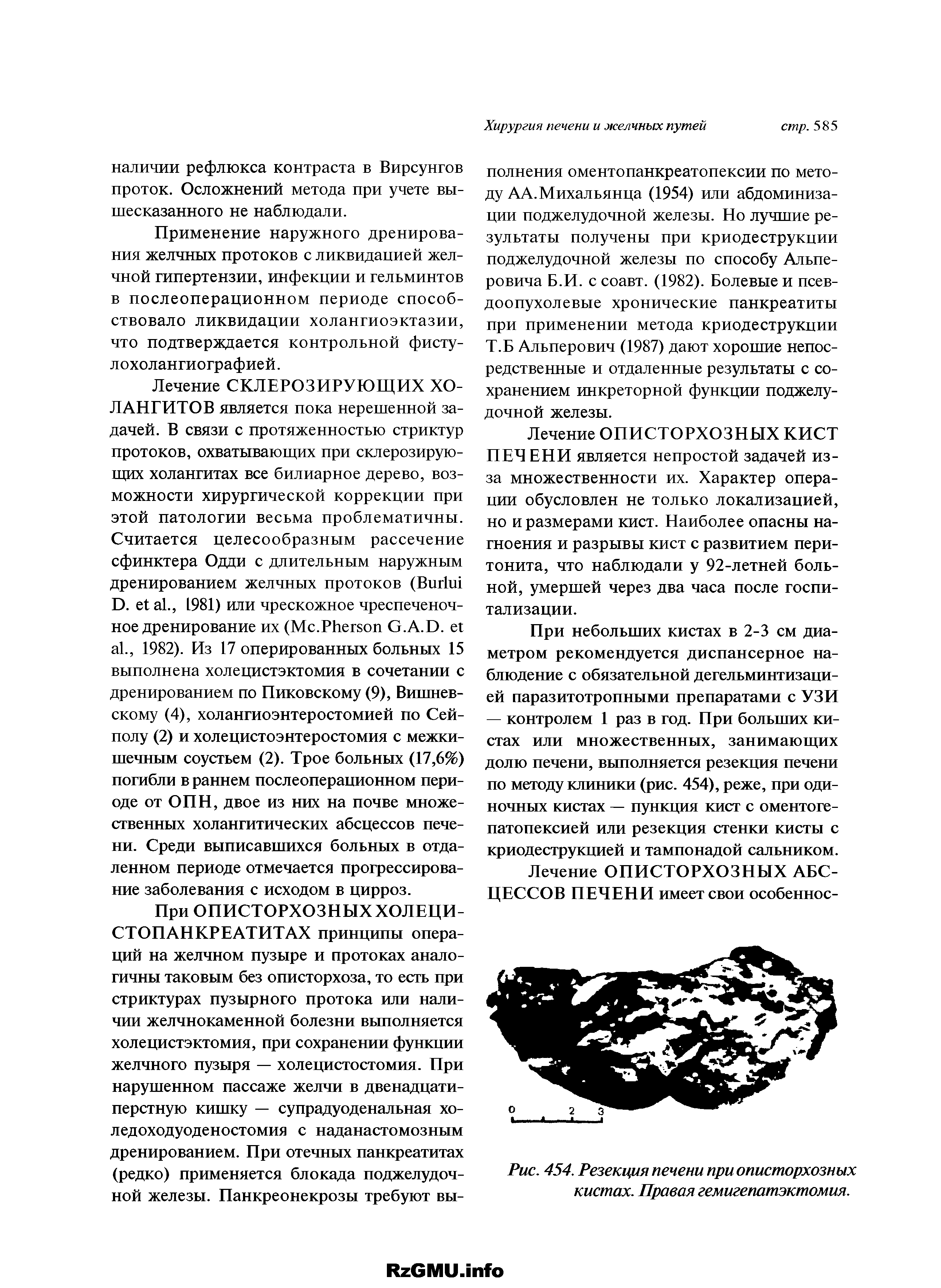 Рис. 454. Резекция печени при описторхозных кистах. Правая гемигепатэктомия.