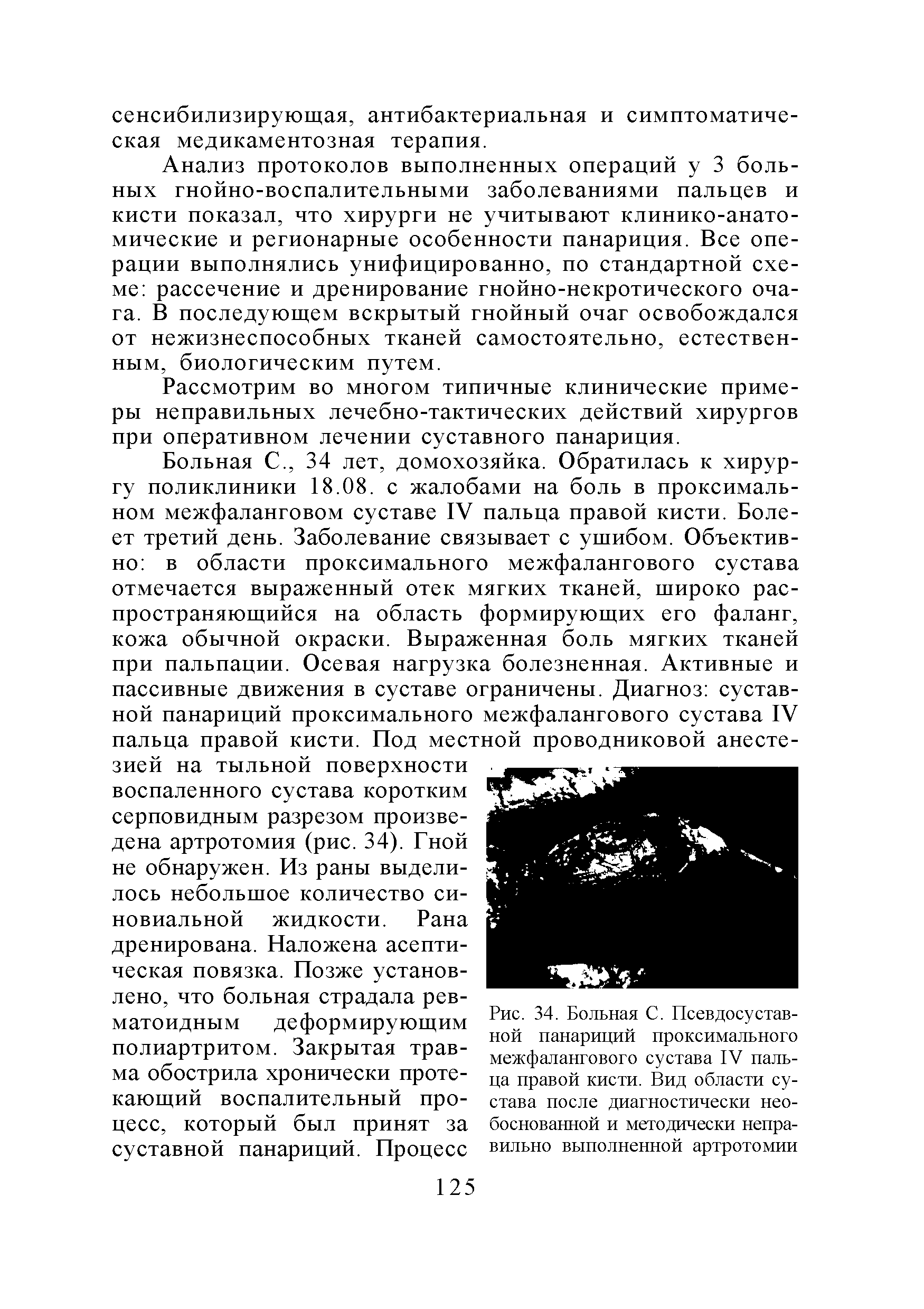 Рис. 34. Больная С. Псевдосустав-ной панариций проксимального межфалангового сустава IV пальца правой кисти. Вид области сустава после диагностически необоснованной и методически неправильно выполненной артротомии...