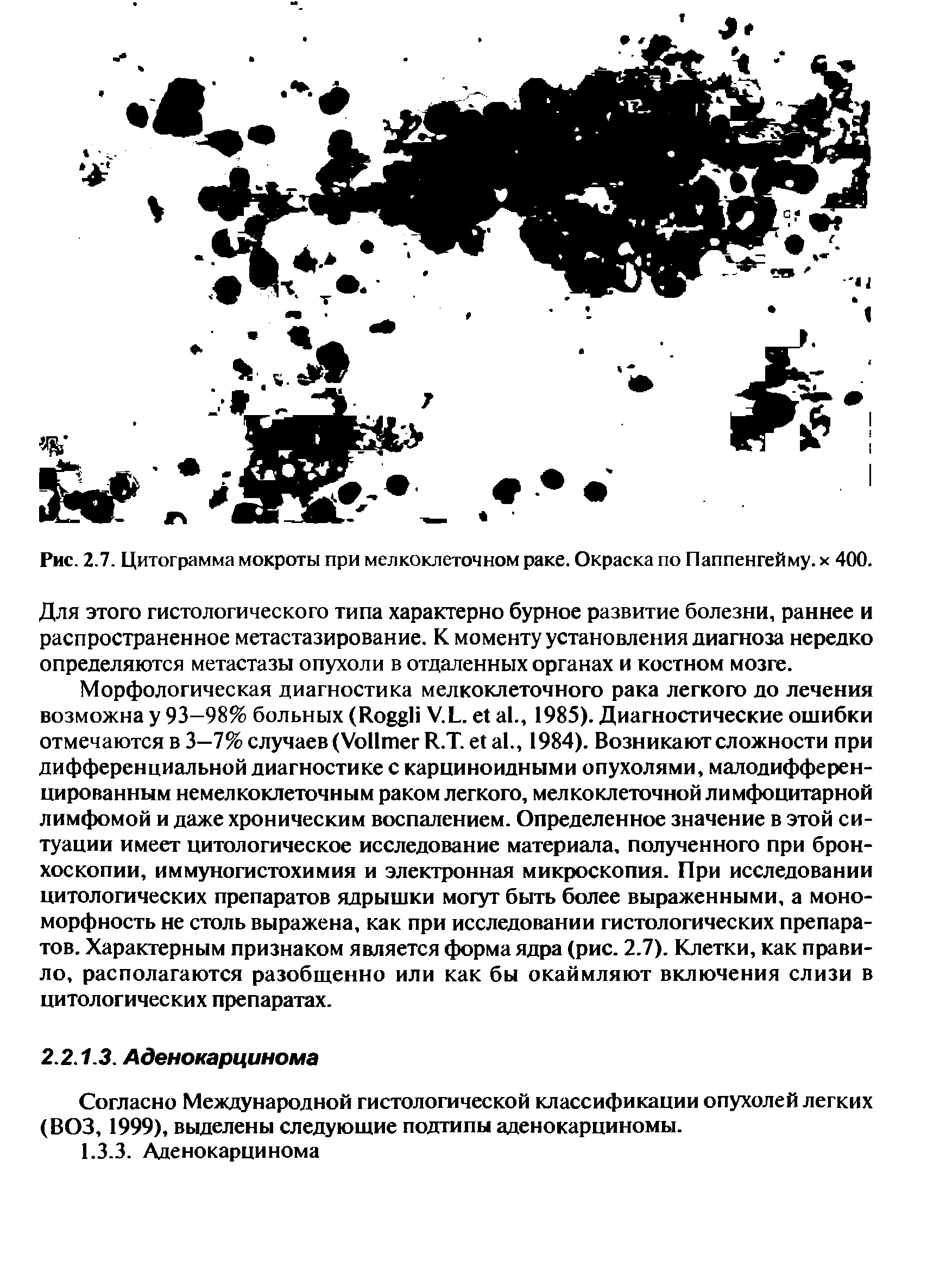 Рис. 2.7. Цитограмма мокроты при мелкоклеточном раке. Окраска по Паппенгейму. х 400.