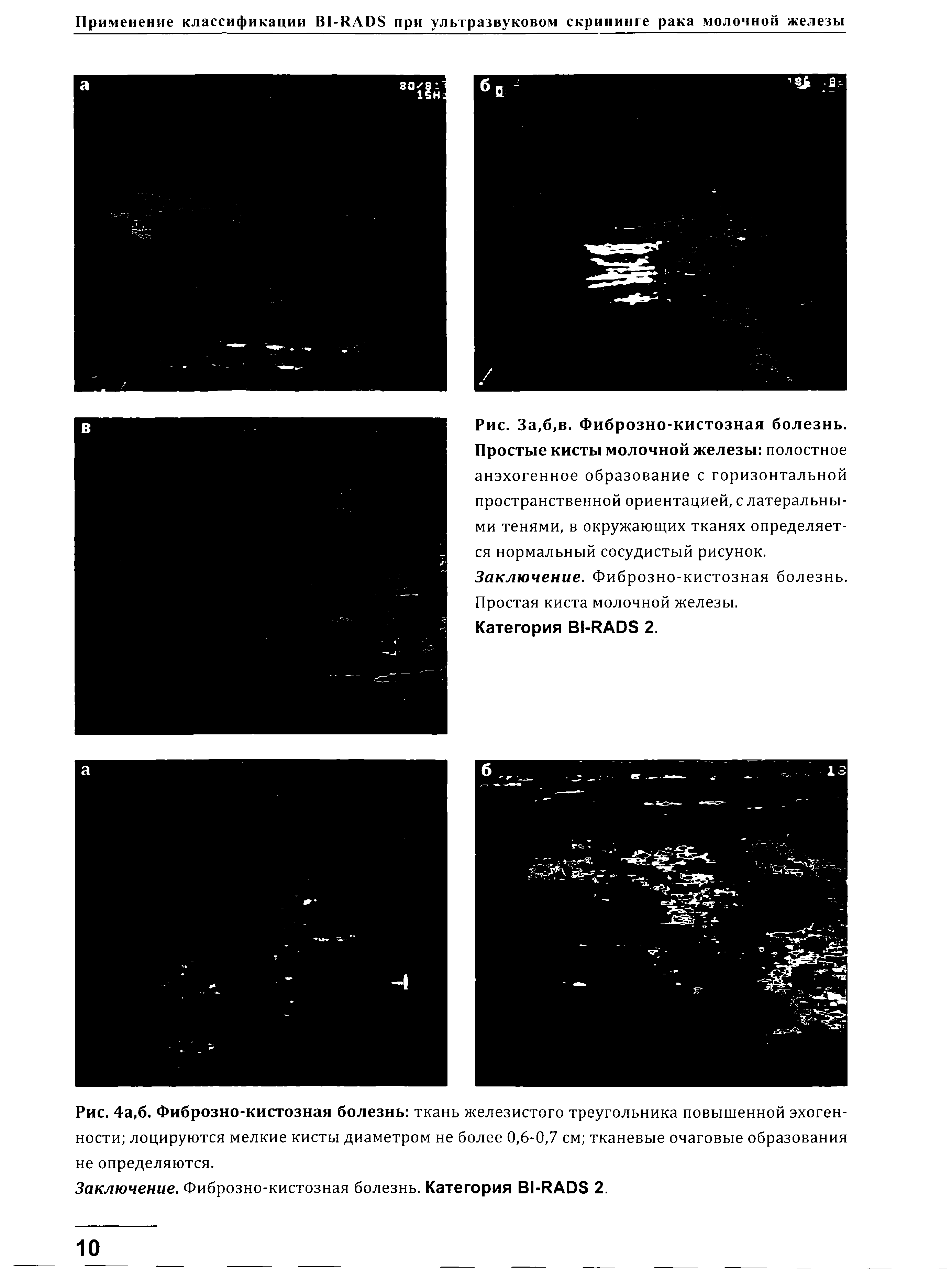 Рис. За,б,в. Фиброзно-кистозная болезнь. Простые кисты молочной железы полостное анэхогенное образование с горизонтальной пространственной ориентацией,с латеральными тенями, в окружающих тканях определяется нормальный сосудистый рисунок.