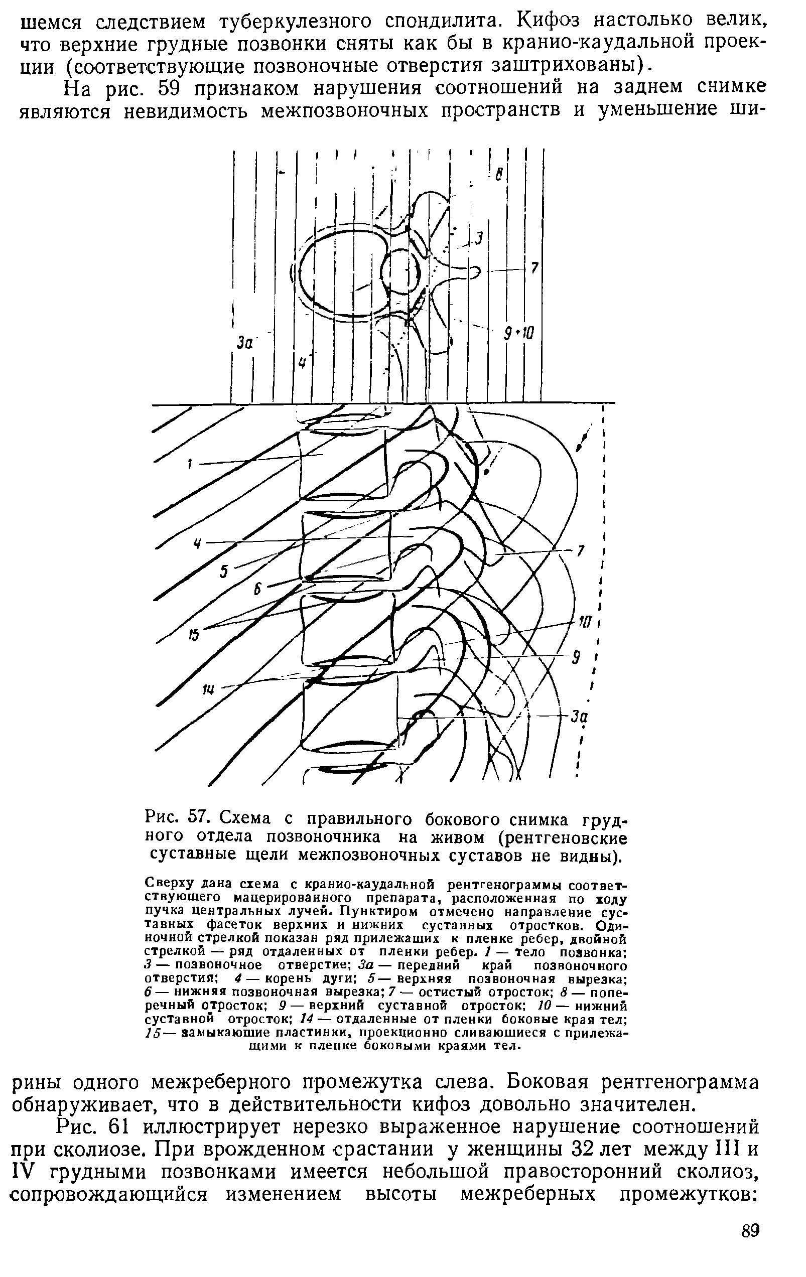 Рис. 57. Схема с правильного бокового снимка грудного отдела позвоночника на живом (рентгеновские суставные щели межпозвоночных суставов не видны).