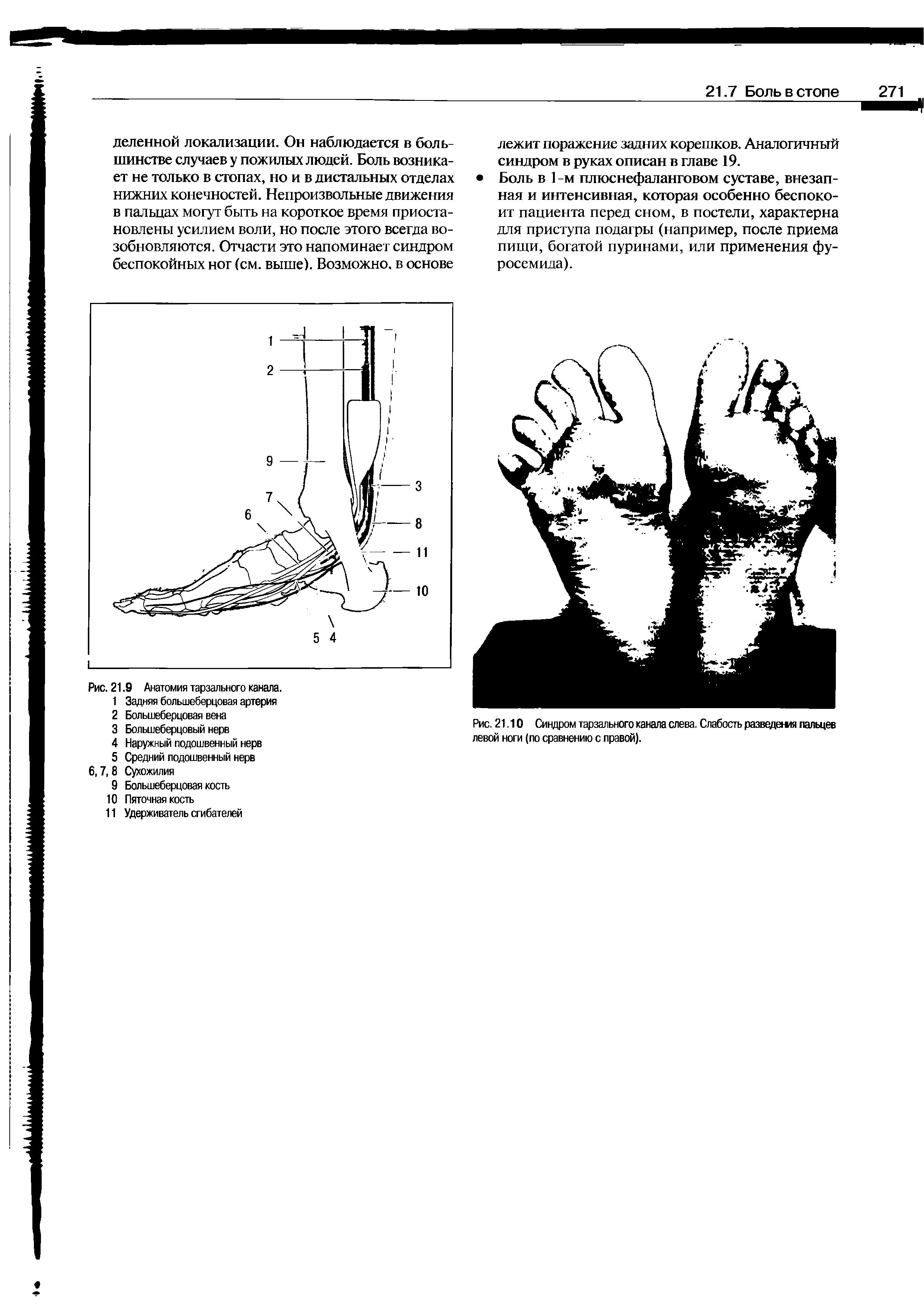 Рис. 21.10 Синдром тарзального канала слева. Слабость разведептя пальцев левой ноги (по сравнению с правой).