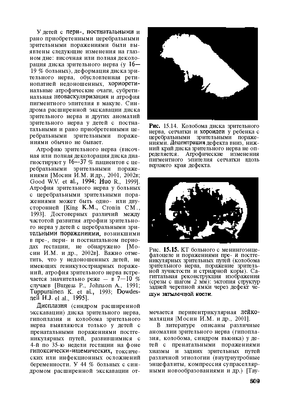 Рис. 15.14. Колобома диска зрительного нерва, сетчатки и хороилеи у ребенка с церебральными зрительными поражениями. Децентрация дефекта вниз, нижний край диска зрительного нерва не определяется. Атрофические изменения пигментного эпителия сетчатки вдоль верхнего края дефекта.