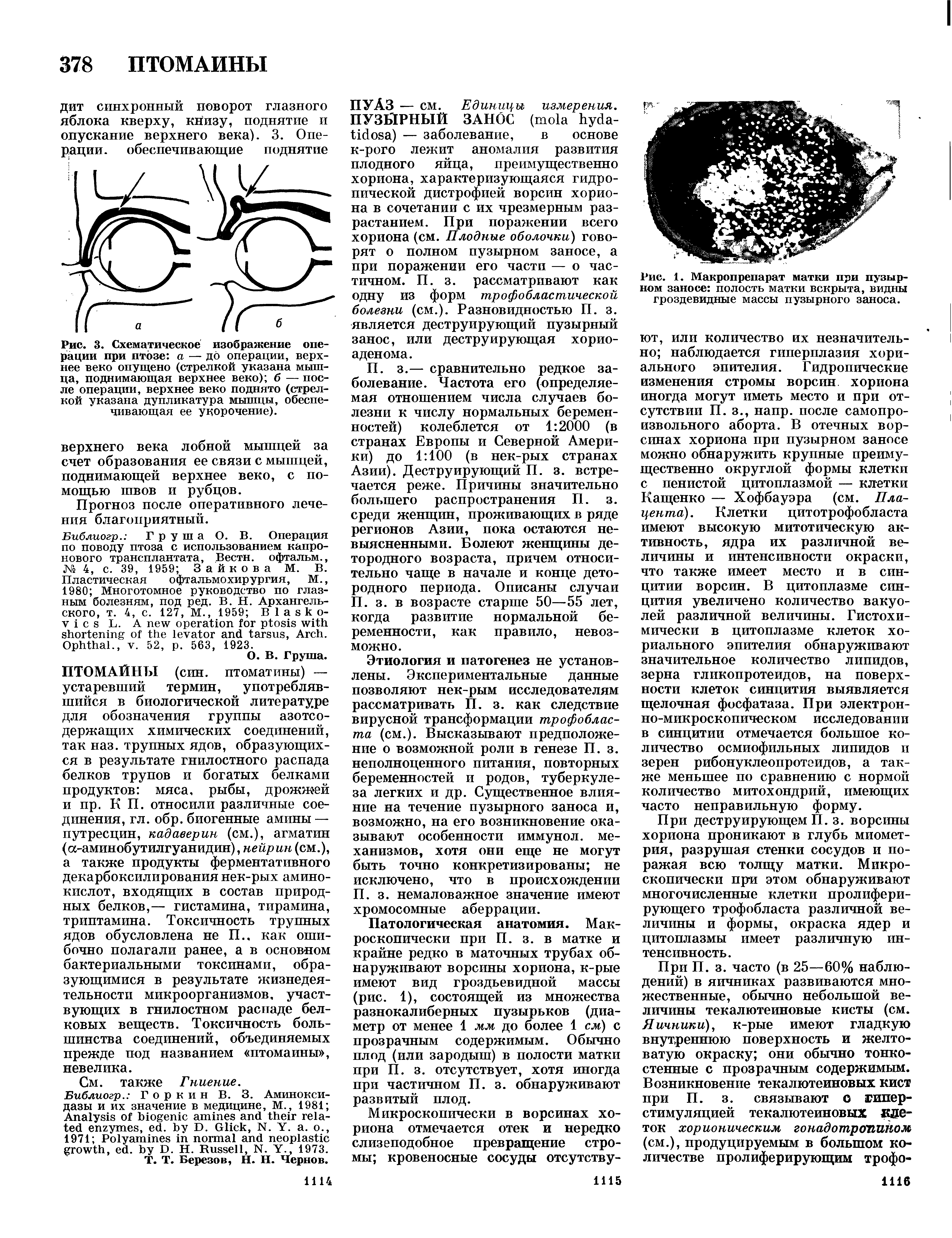 Рис. 1. Макропрепарат матки при пузырном заносе полость матки вскрыта, видны гроздевидные массы пузырного заноса.