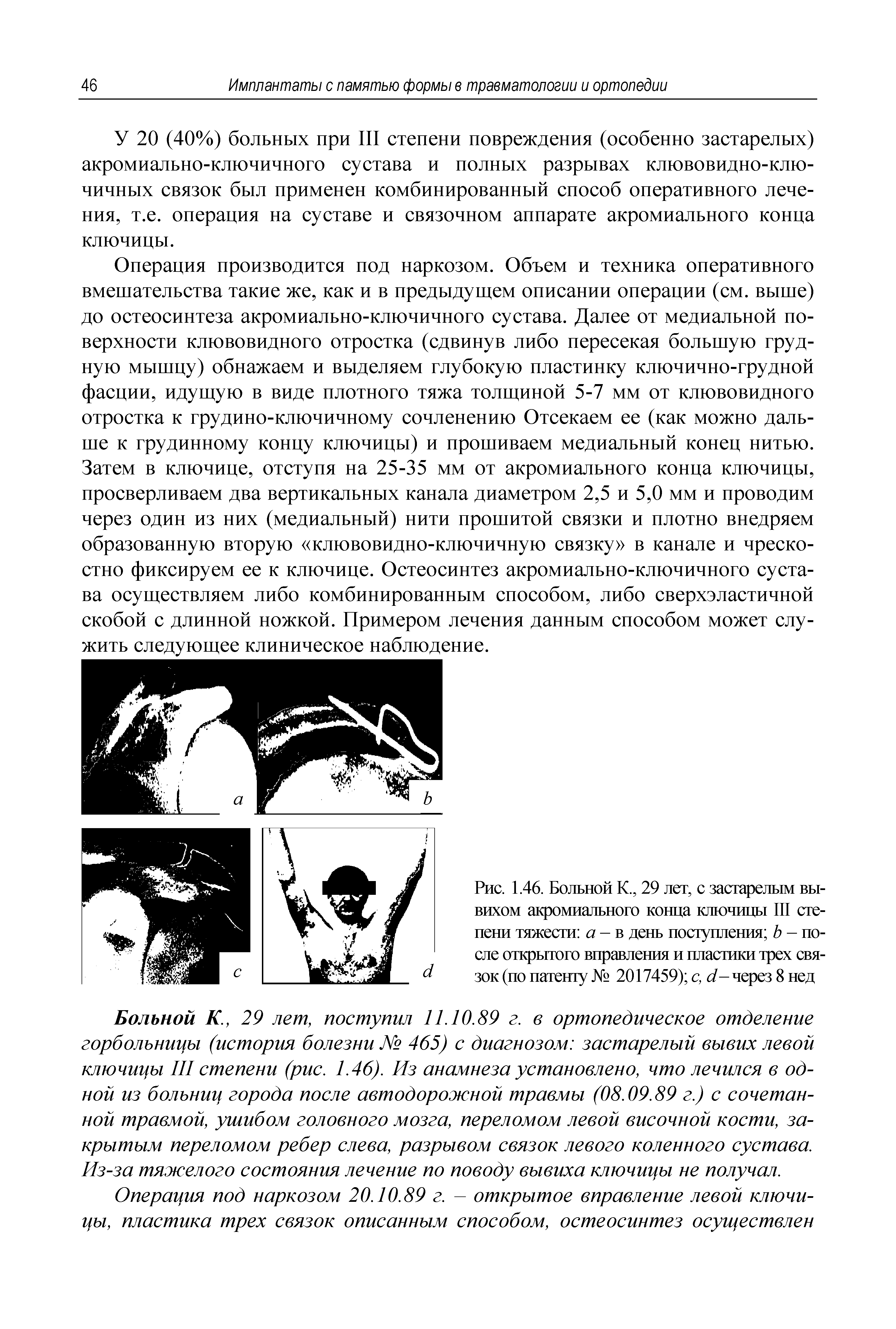 Рис. 1.46. Больной К., 29 лет, с застарелым вывихом акромиального конца ключицы III степени тяжести а - в день поступления Ь - после открытого вправления и пластики трех связок (по патенту № 2017459) с, /-через 8 нед...