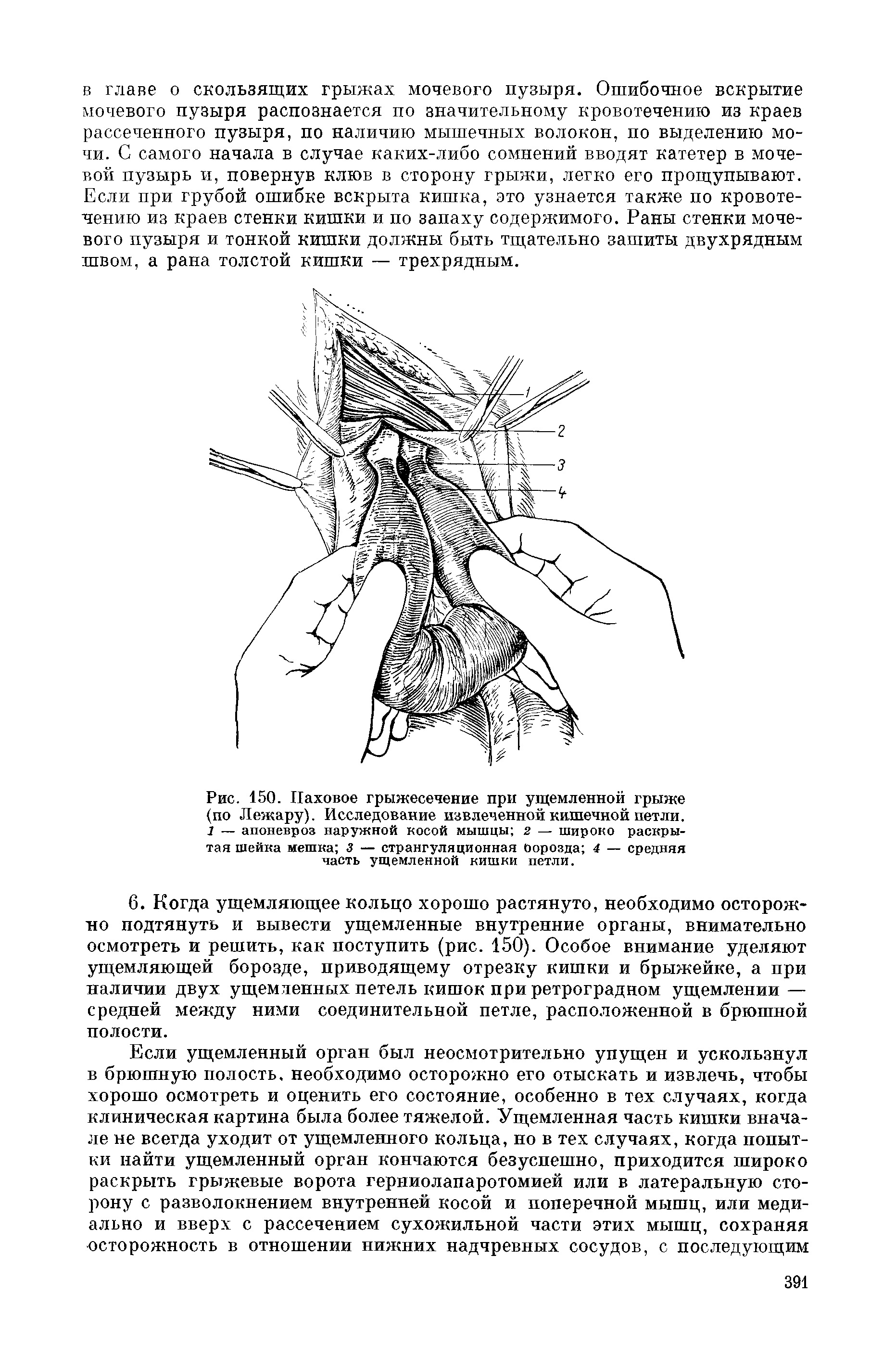 Рис. 150. Паховое грыжесечение при ущемленной грыже (по Лежару). Исследование извлеченной кишечной петли. 1 — апоневроз наружной косой мышцы 2 — широко раскрытая шейка мешка 3 — странгуляционная оорозда 4 — средняя часть ущемленной кишки петли.