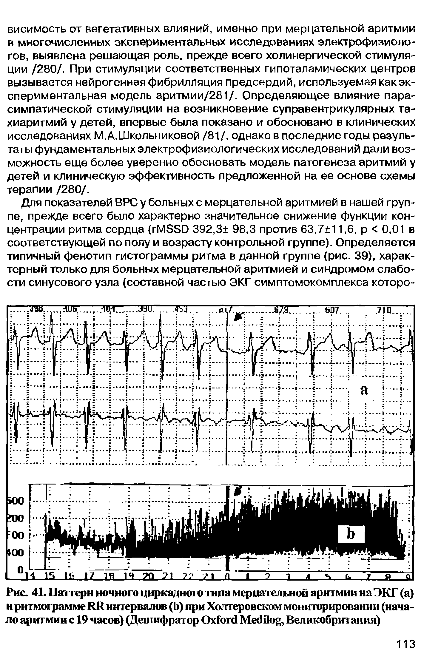 Рис. 41. Паттерн ночного циркадного типа мерцательной аритмии на ЭКГ (а) и ритмограмме RR интервалов (Ь) при Холтеровском мониторировании (начало аритмии с 19 часов) (Дешифратор O M , Великобритания)...