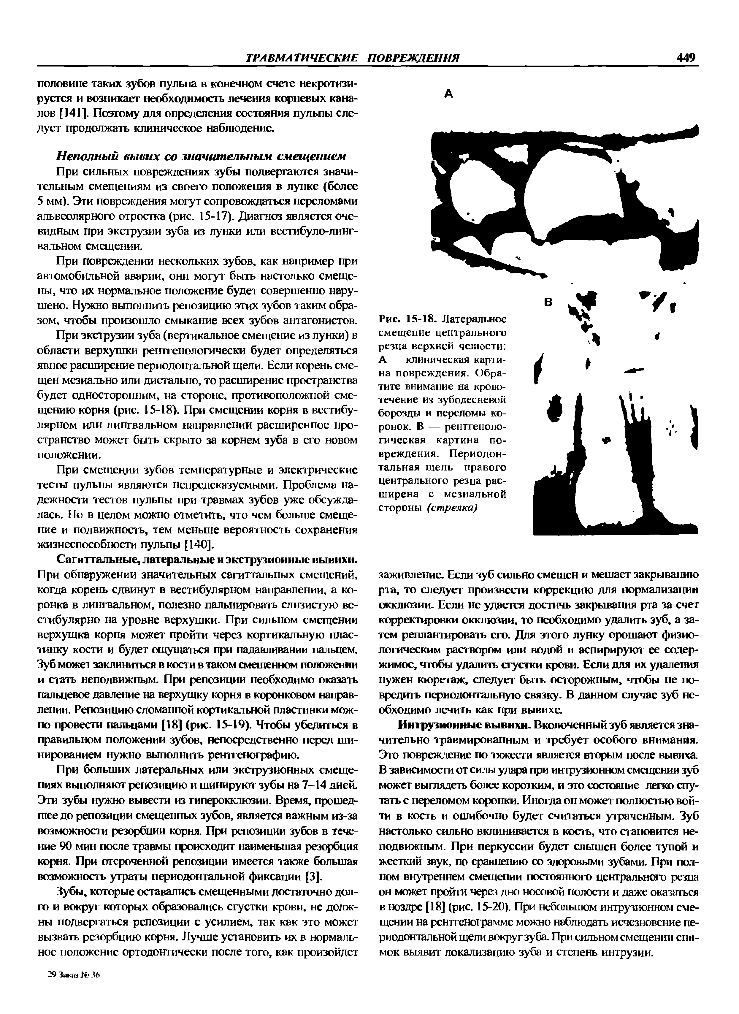 Рис. 15-18. Латеральное смещение центрального резца верхней челюсти А— клиническая картина повреждения. Обратите внимание на кровотечение из зубодесневой борозды и переломы коронок. В — рентгенологическая картина повреждения. Периодонтальная щель правого центрального резца расширена с мезиальной стороны (стрелка)...