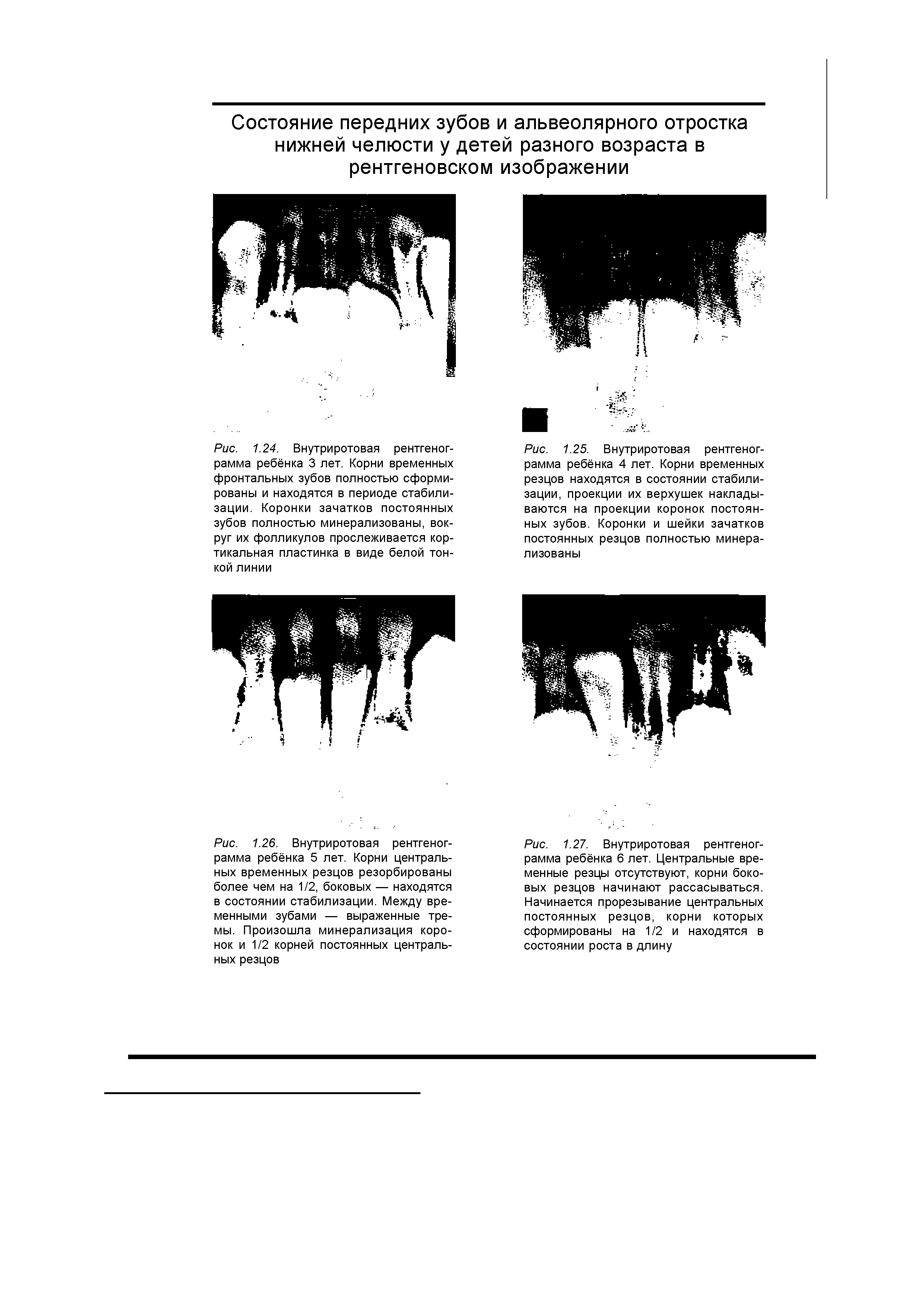 Рис. 1.27. Внутриротовая рентгенограмма ребёнка 6 лет. Центральные временные резцы отсутствуют, корни боковых резцов начинают рассасываться. Начинается прорезывание центральных постоянных резцов, корни которых сформированы на 1/2 и находятся в состоянии роста в длину...