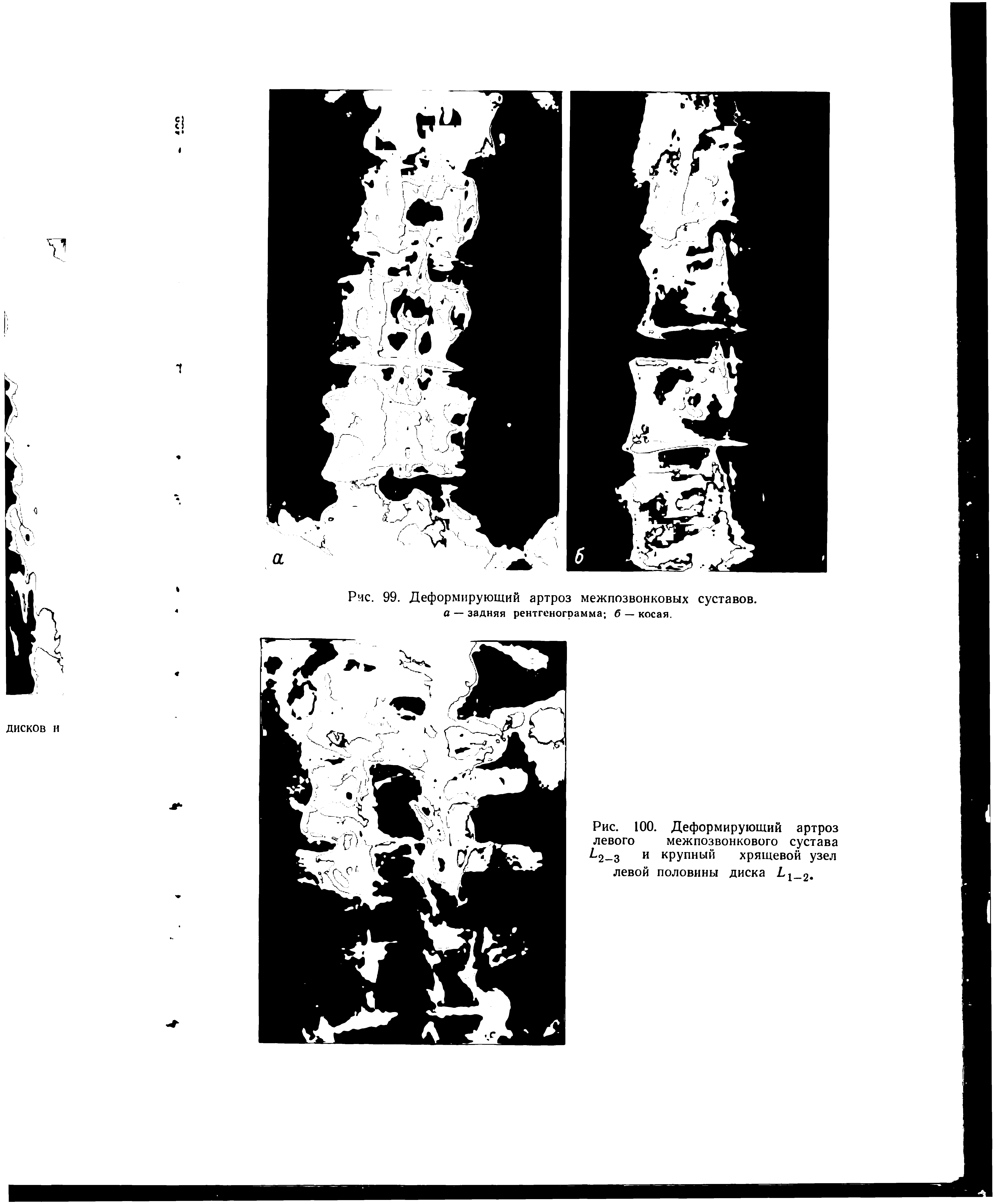 Рис. 100. Деформирующий артроз левого межпозвонкового сустава 2 з и крупный хрящевой узел левой половины диска 1 2.
