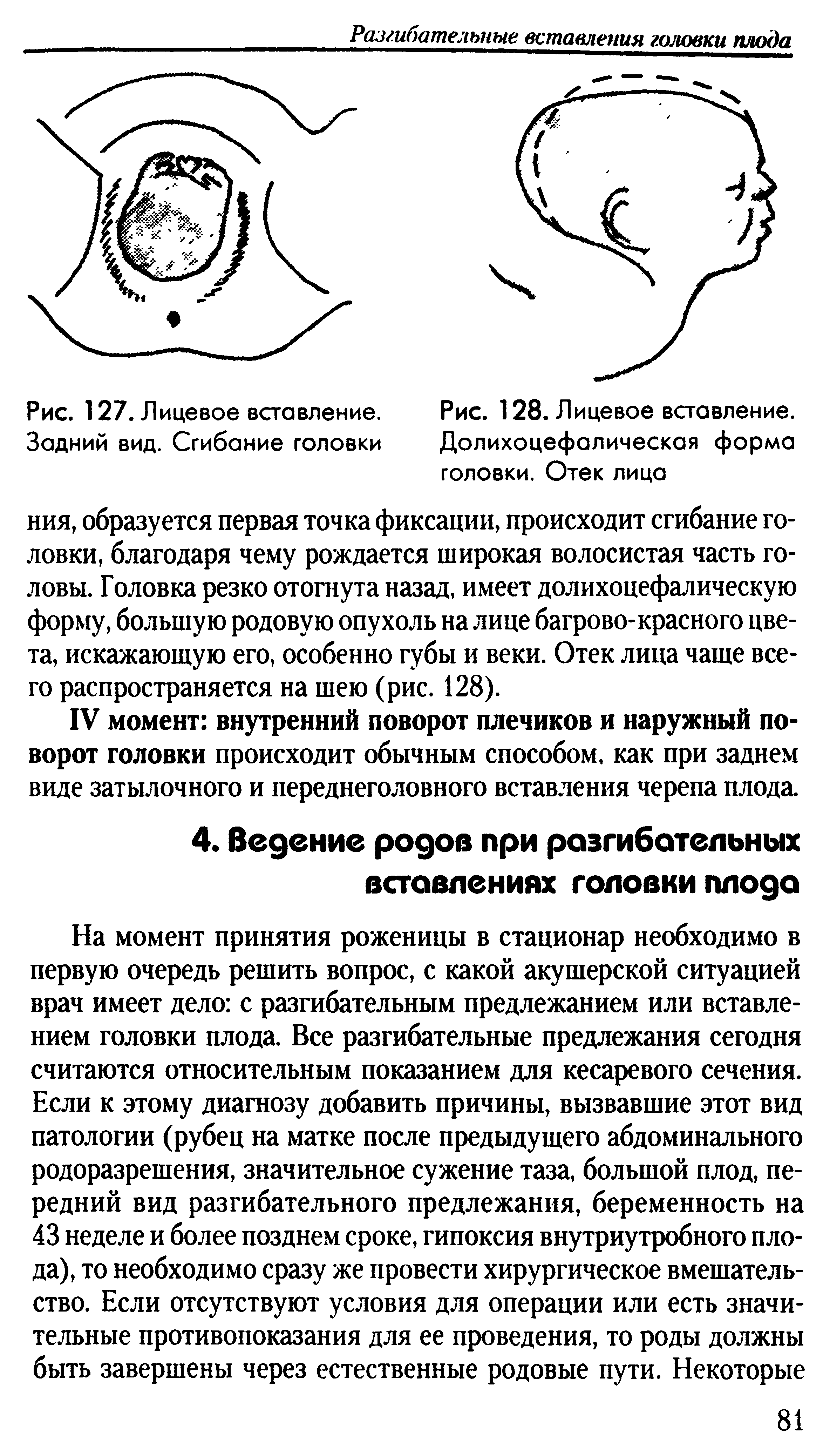 Рис. 128. Лицевое вставление. Долихоцефалическая форма головки. Отек лица...