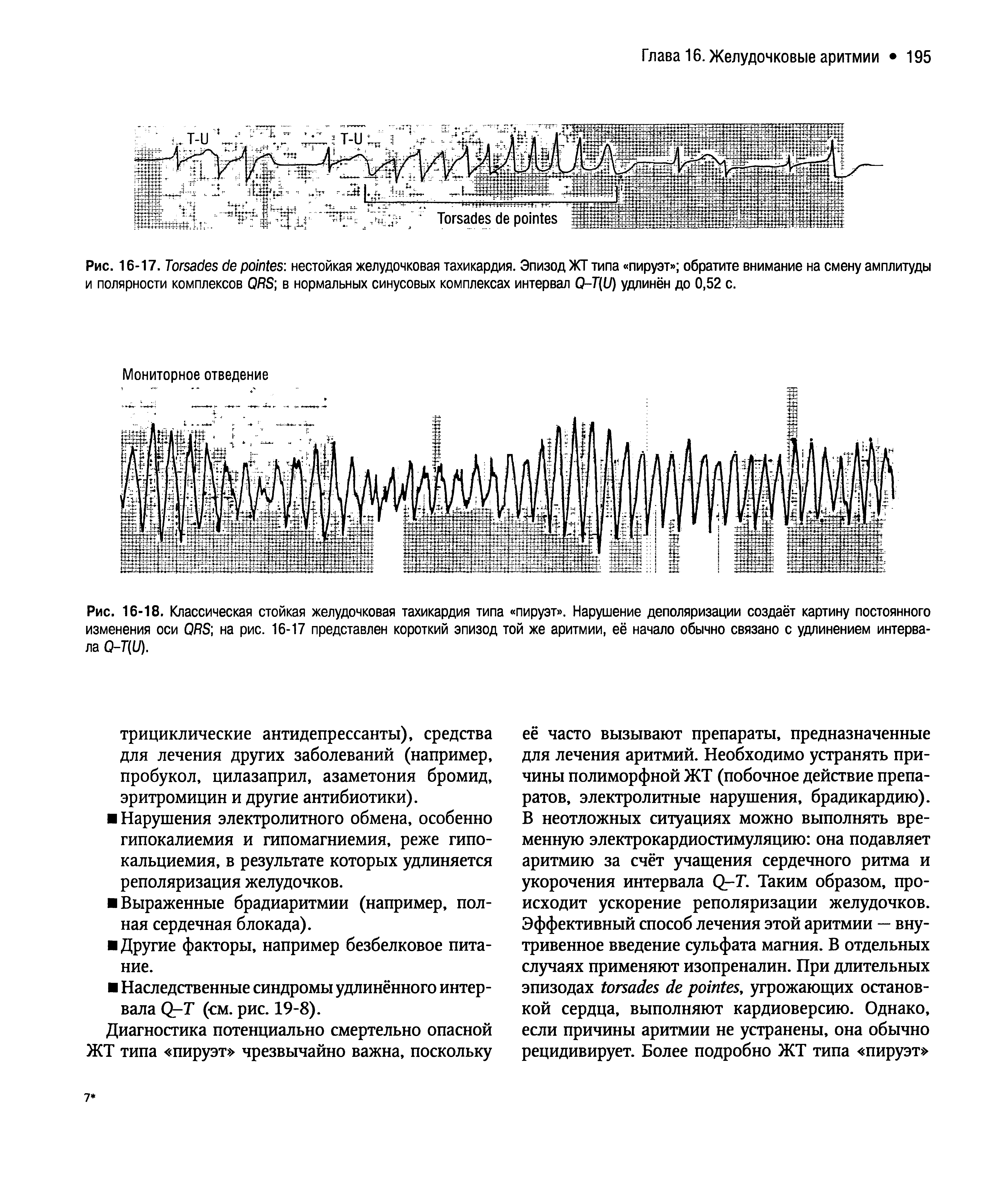 Рис. 16-18. Классическая стойкая желудочковая тахикардия типа пируэт . Нарушение деполяризации создаёт картину постоянного изменения оси ОЯБ на рис. 16-17 представлен короткий эпизод той же аритмии, её начало обычно связано с удлинением интервала 0-7(1/).