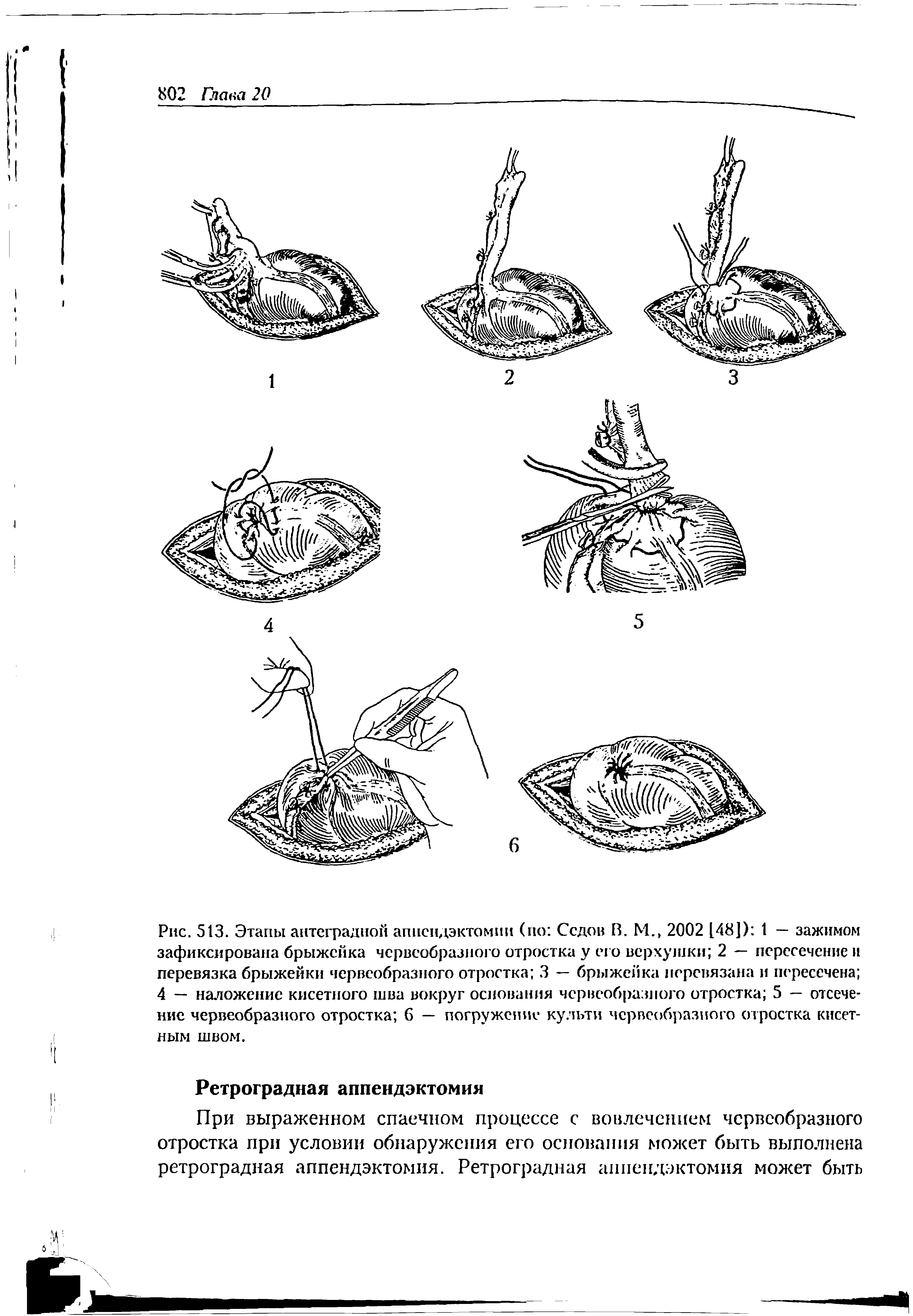 Рис. 513. Этапы антеградной аппендэктомии (по Седов В. М., 2002 [48]) 1 — зажимом зафиксирована брыжейка червеобразного отростка у его верхушки 2 — пересечение и перевязка брыжейки червеобразного отростка 3 — брыжейка перевязана и пересечена 4 — наложение кисетного шва вокруг основания червеобразного отростка 5 — отсечение червеобразного отростка 6 — погружение культи червеобразного отростка кисетным швом.