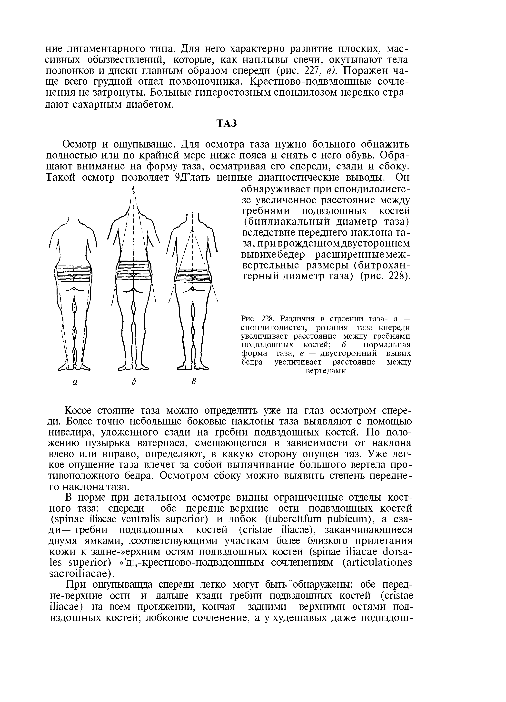 Рис. 228. Различия в строении таза- а — спондилолистез, ротация таза кпереди увеличивает расстояние между гребнями подвздошных костей б — нормальная форма таза в — двусторонний вывих бедра увеличивает расстояние между вертелами...