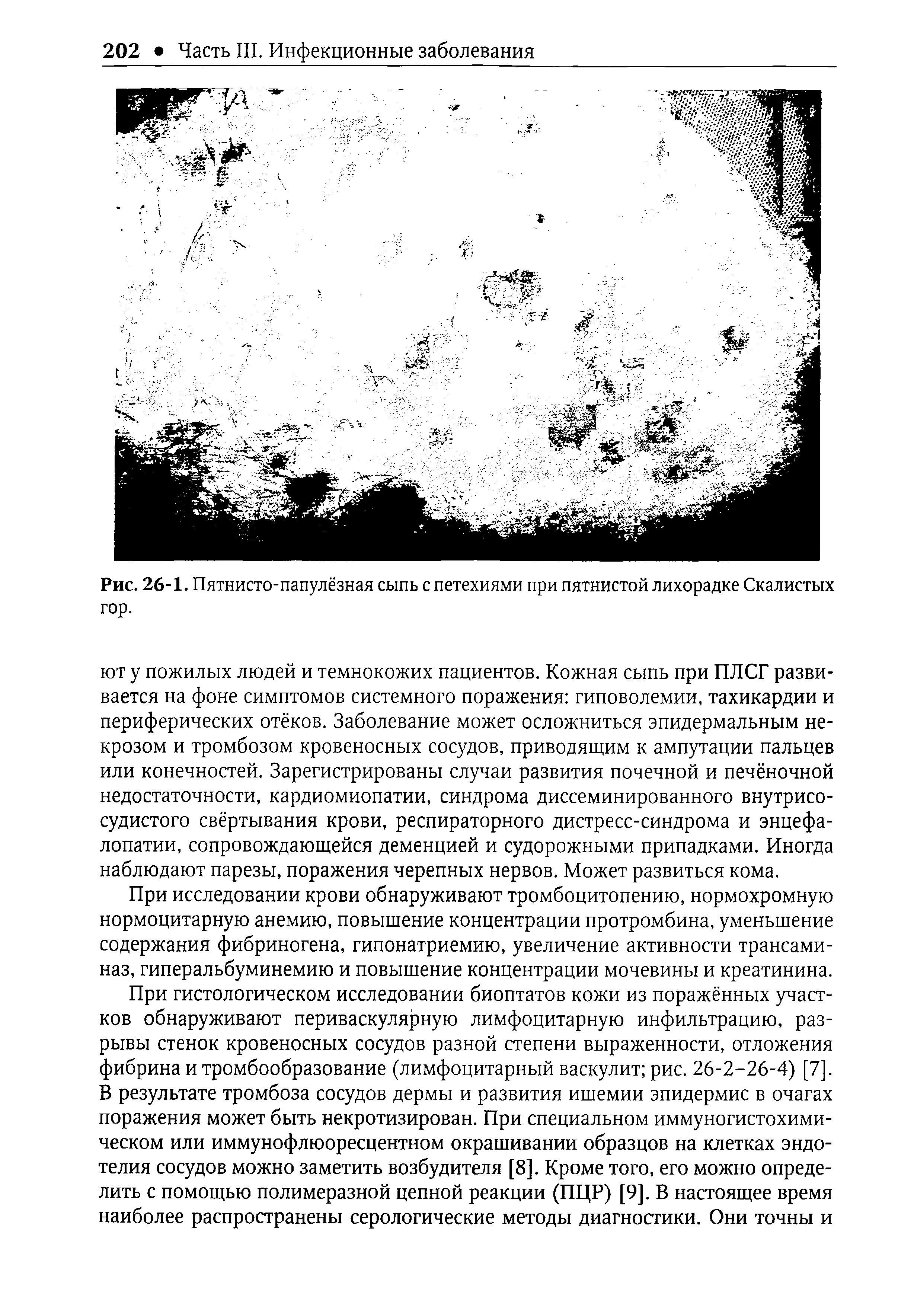 Рис. 26-1. Пятнисто-папулёзная сыпь с петехиями при пятнистой лихорадке Скалистых гор.