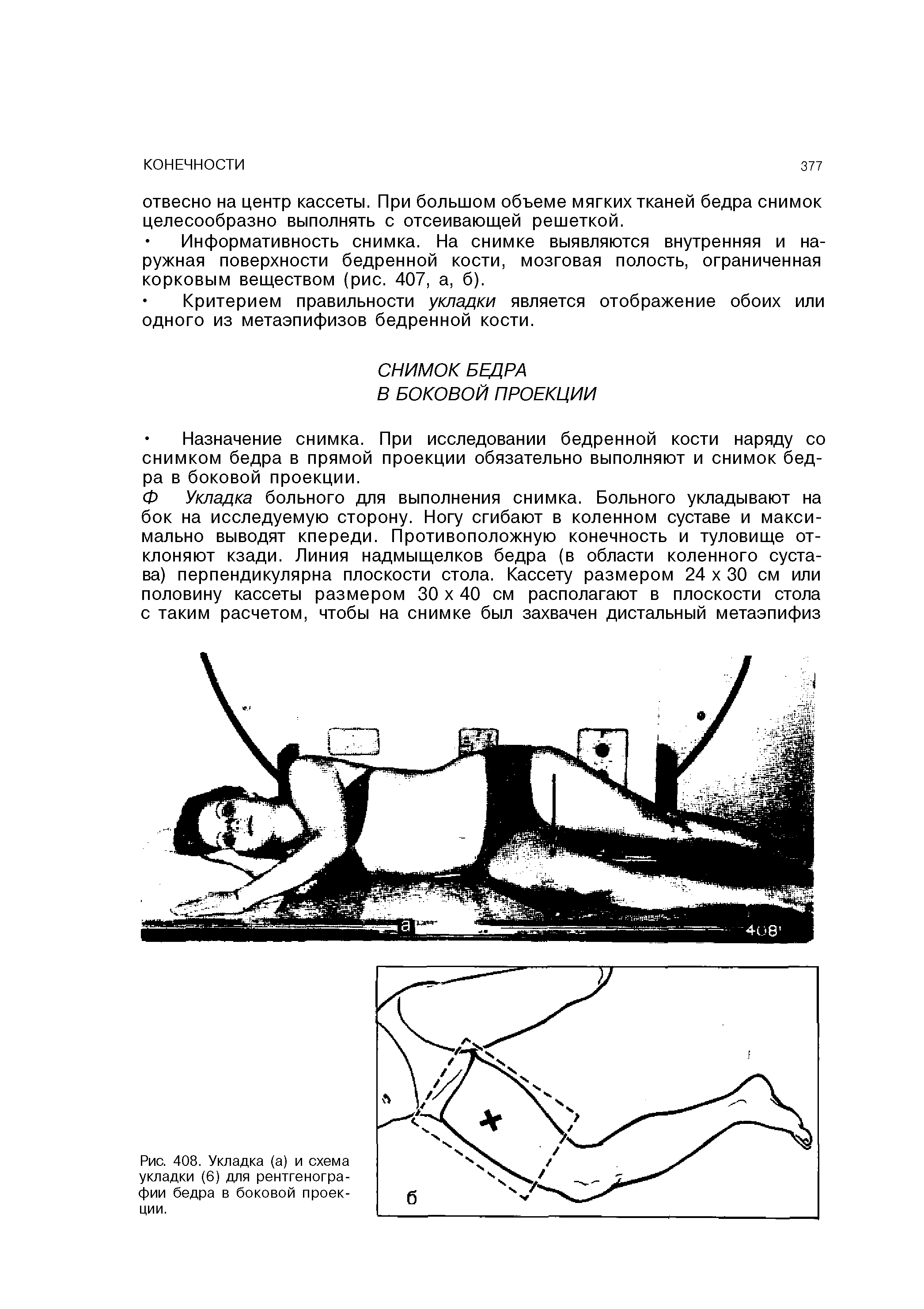 Рис. 408. Укладка (а) и схема укладки (6) для рентгенографии бедра в боковой проекции.