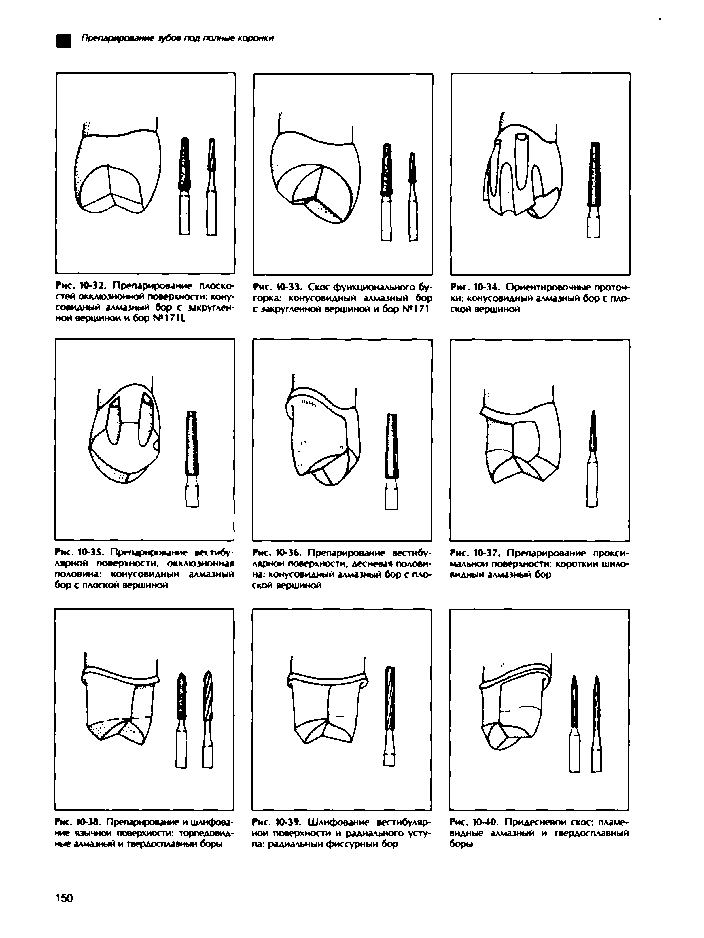 Рис. Ю-32. Препарирование плоскостей окклюзионной поверхности конусовидный алмазный бор с закругленной вершиной и бор N 1711...
