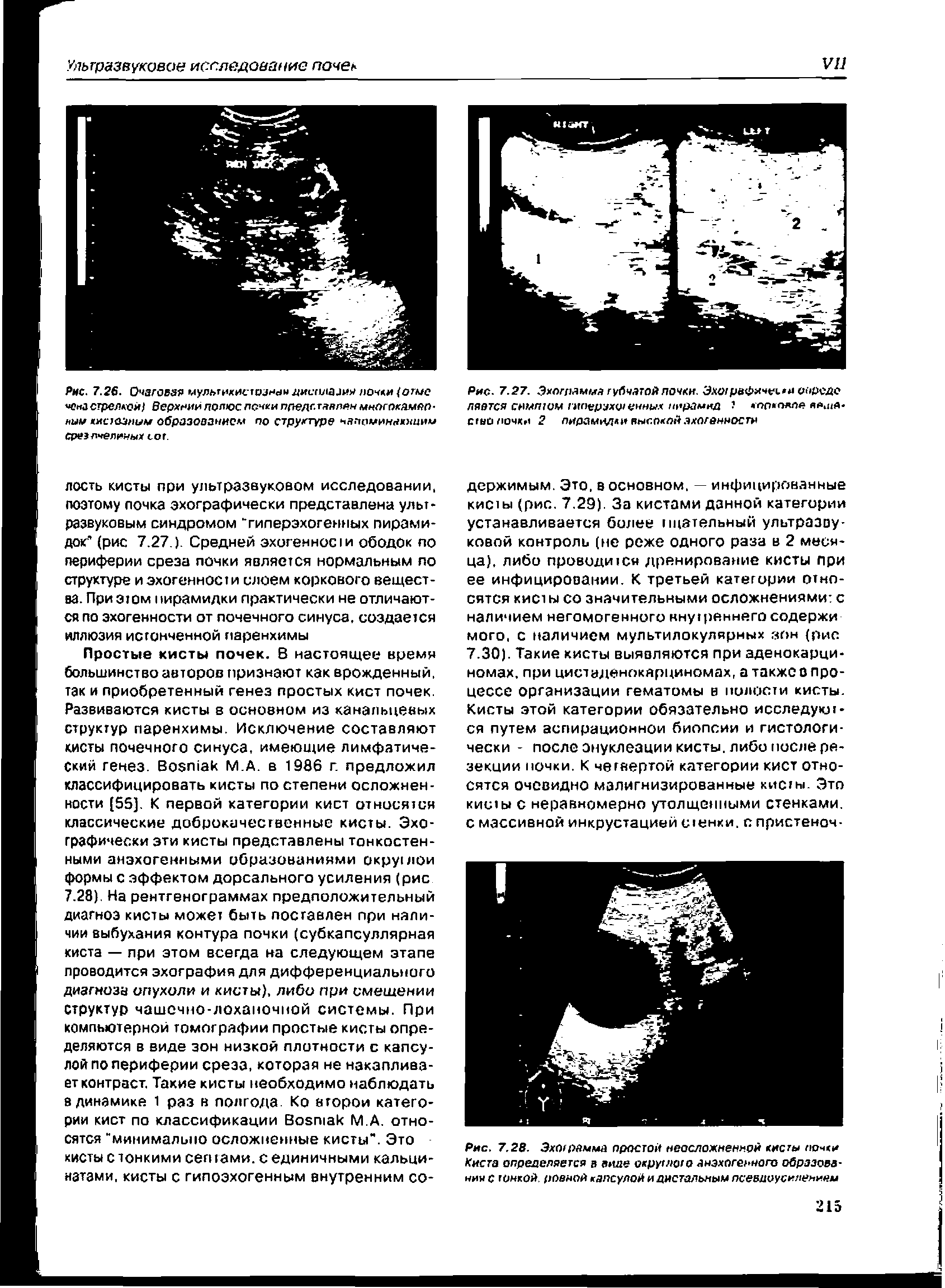 Рис. 7.26. Очагоезя мул >гикисгозне1ыдис(и1аииялоч и/огмс о асгрелА-фй) Верхний полюс почки пдедг.гавлйн многпкамеп-ныи кистозным образованием по структуре чяпомин кхиим сризлчелииых сог.