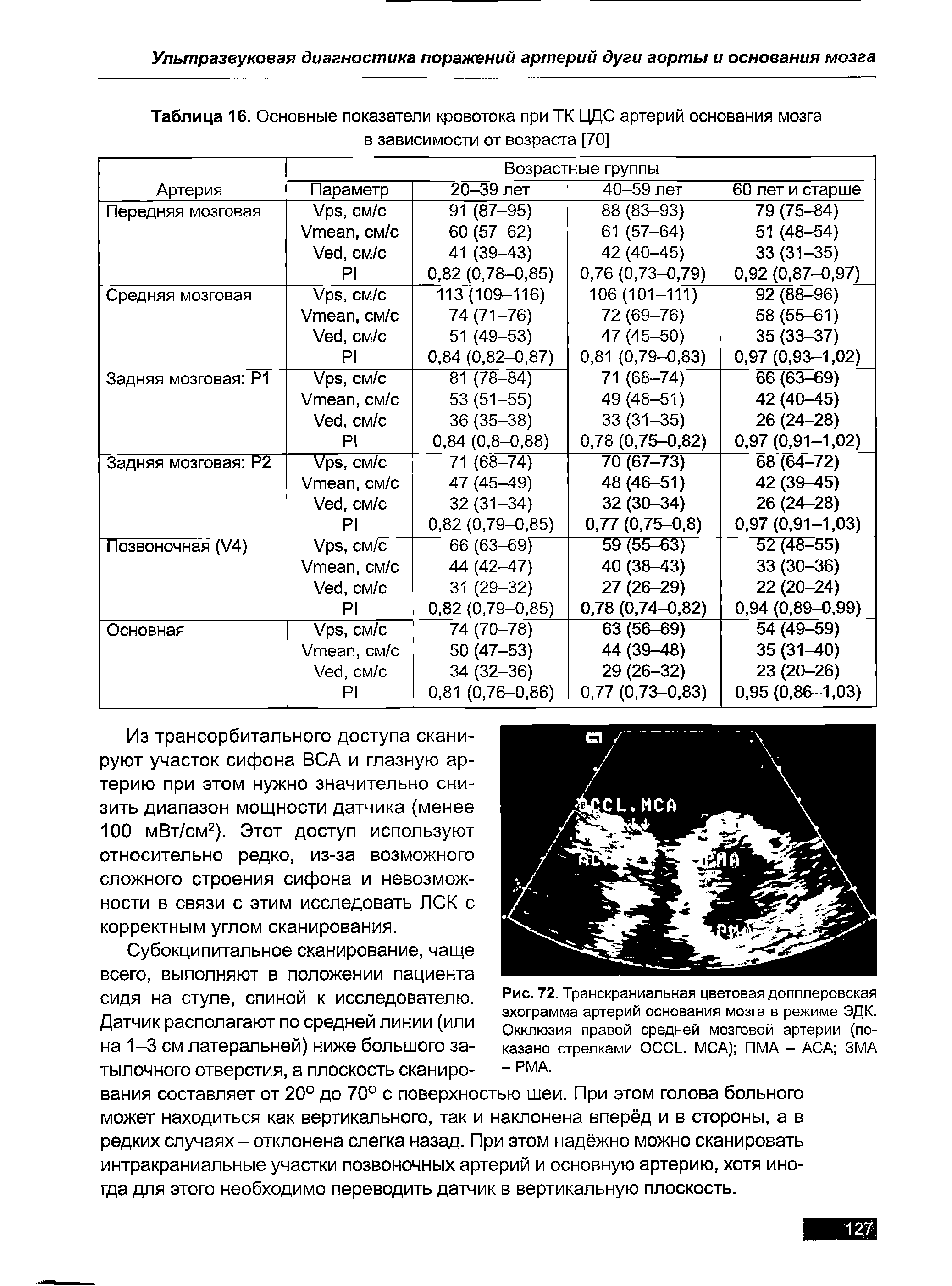 Рис. 72. Транскраниальная цветовая допплеровская эхограмма артерий основания мозга в режиме ЭДК. Окклюзия правой средней мозговой артерии (показано стрелками OCCL. MCA) ПМА - АСА ЗМА -РМА.