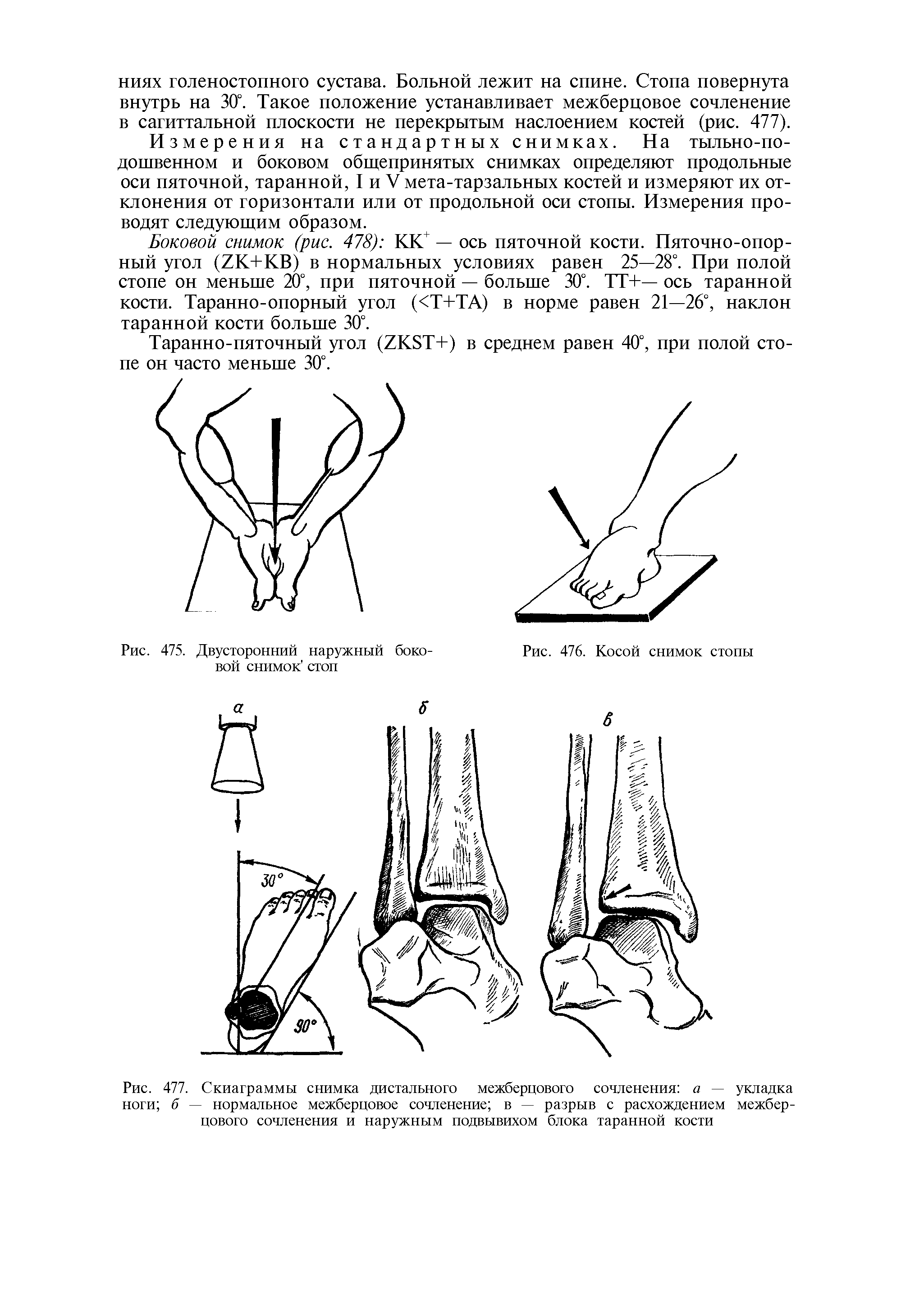 Рис. 477. Скиаграммы снимка дистального межберцового сочленения а — укладка ноги б — нормальное межберцовое сочленение в — разрыв с расхождением межберцового сочленения и наружным подвывихом блока таранной кости...