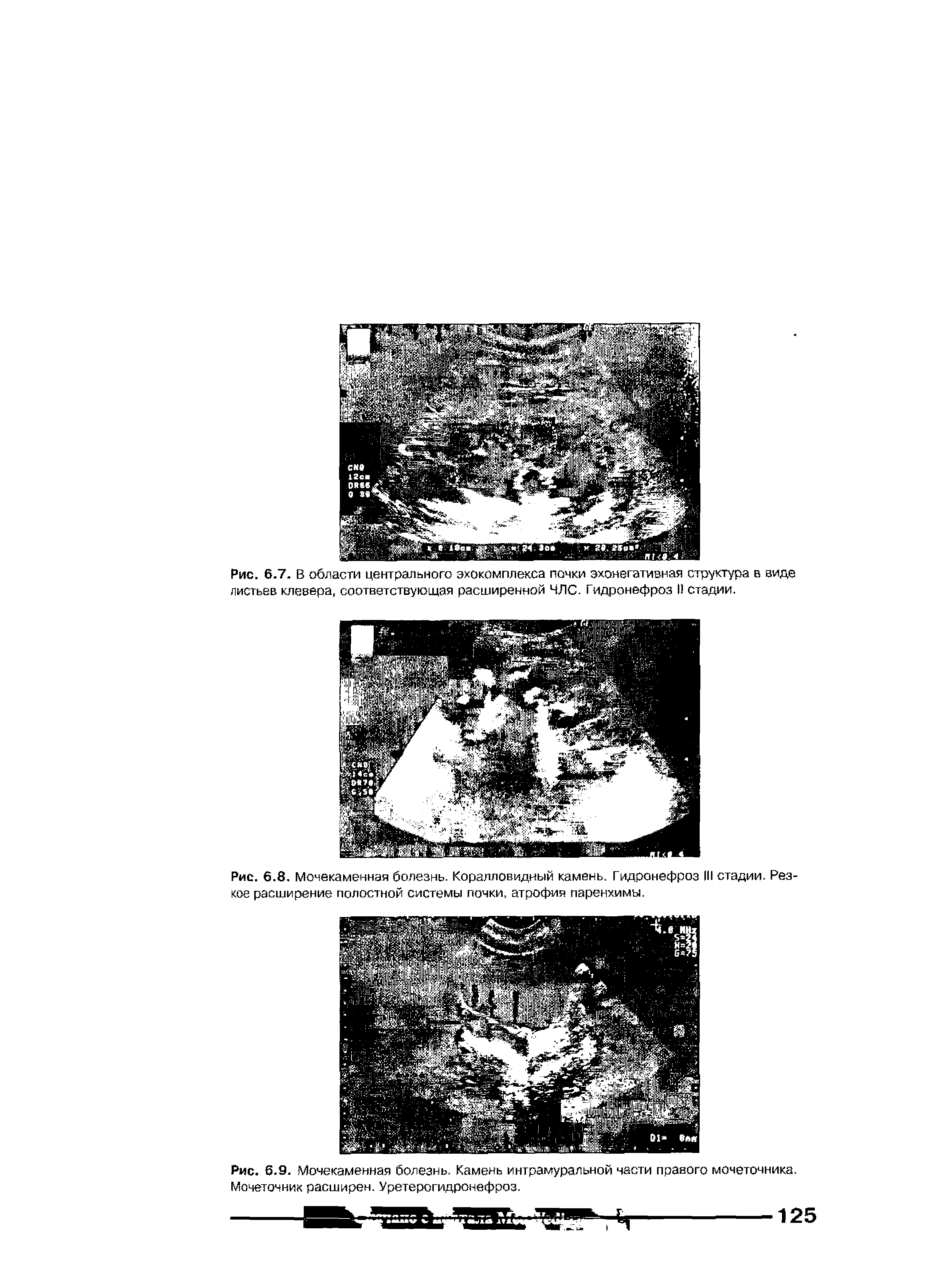 Рис. 6.8. Мочекаменная болезнь. Коралловидный камень. Гидронефроз III стадии. Резкое расширение полостной системы почки, атрофия паренхимы.