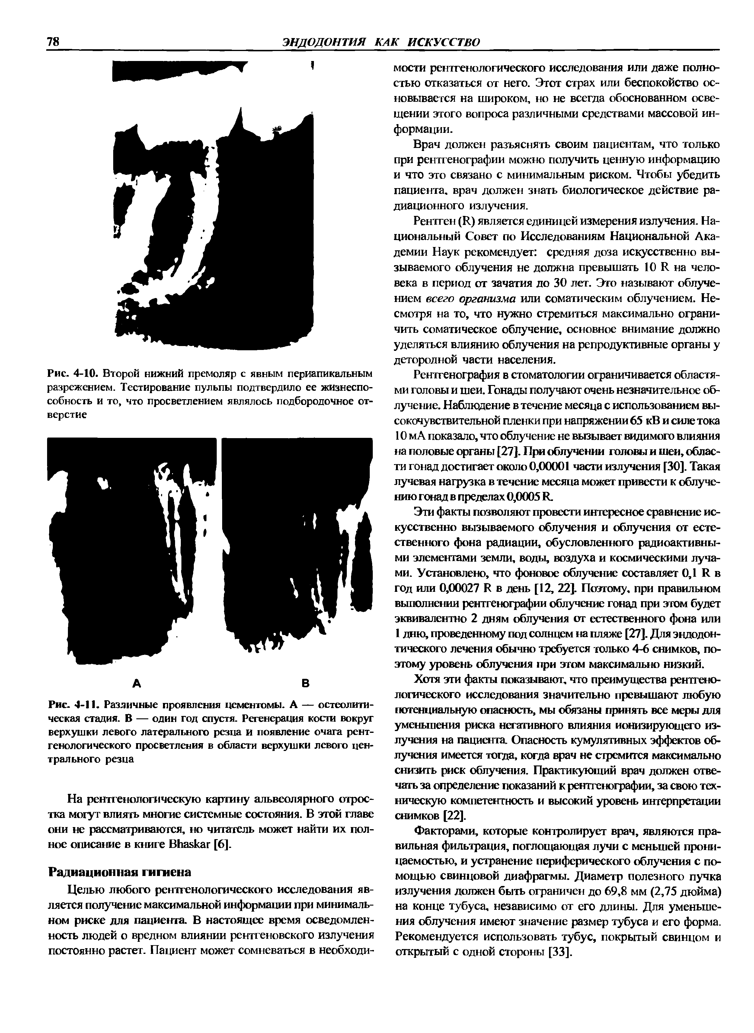 Рис. 4-11. Различные проявления цементомы. А — остеолитическая стадия. В — один год спустя. Регенерация кости вокруг верхушки левого латерального резца и появление очага рентгенологического просветления в области верхушки левого центрального резца...