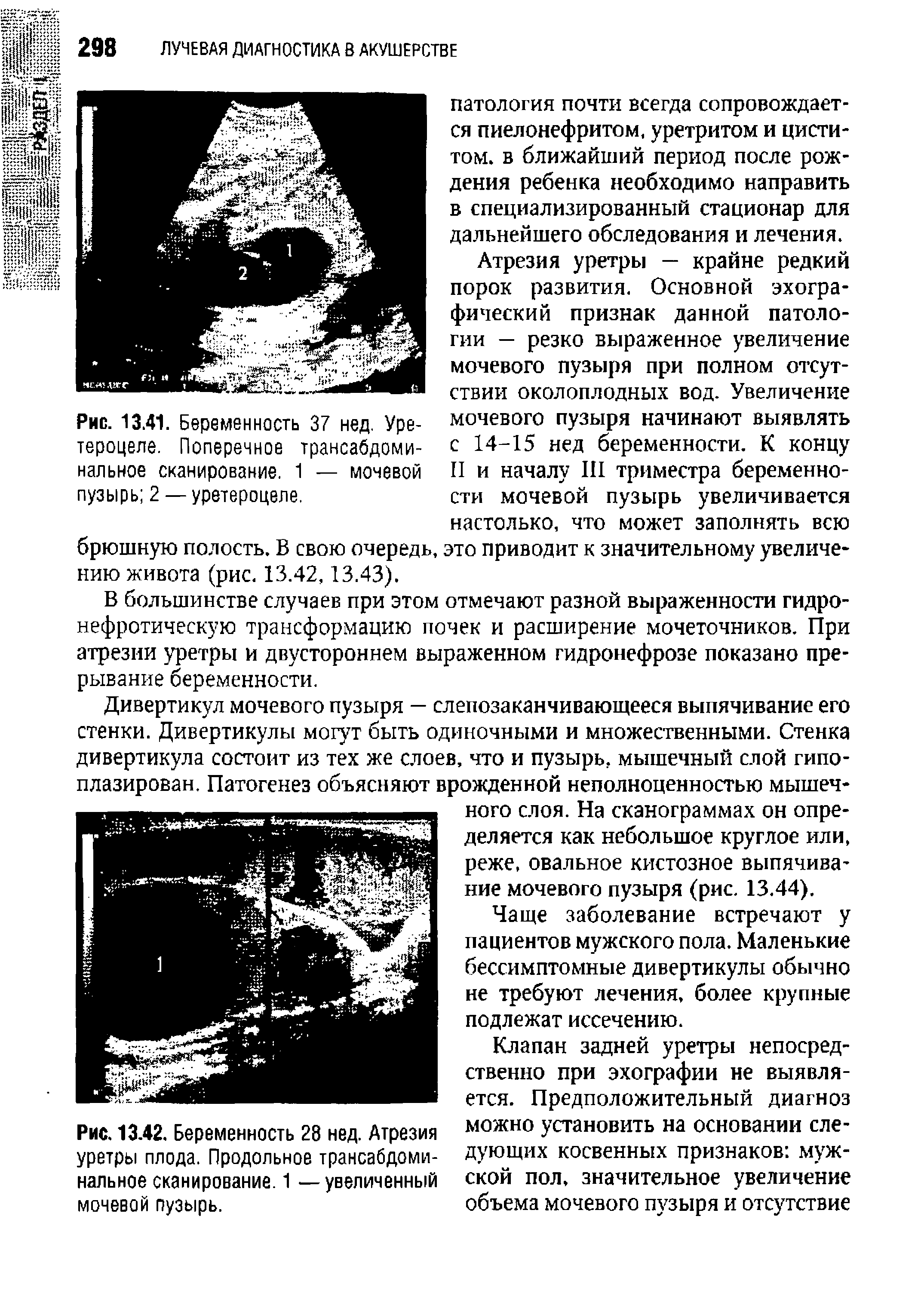 Рис. 13.42. Беременность 28 нед. Атрезия уретры плода. Продольное трансабдоминальное сканирование. 1 —увеличенный мочевой пузырь.