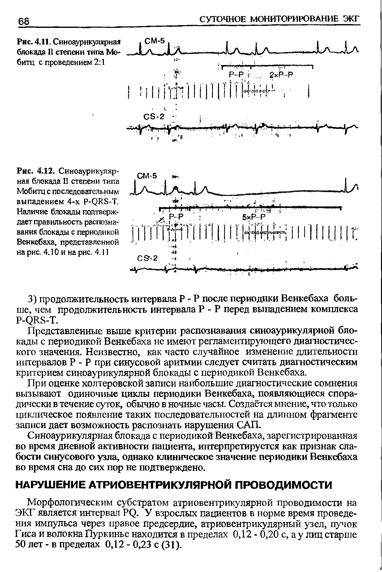 Рис. 4.12. Синоаурикулярная блокада П степени типа Мобитц с последовательным выпадением 4-х Р-(2И8-Т. Наличие блокады подтверждает правильность распознавания блокады с периодикой Венкебаха, представленной на рис. 4.10 и на рис. 4.11...