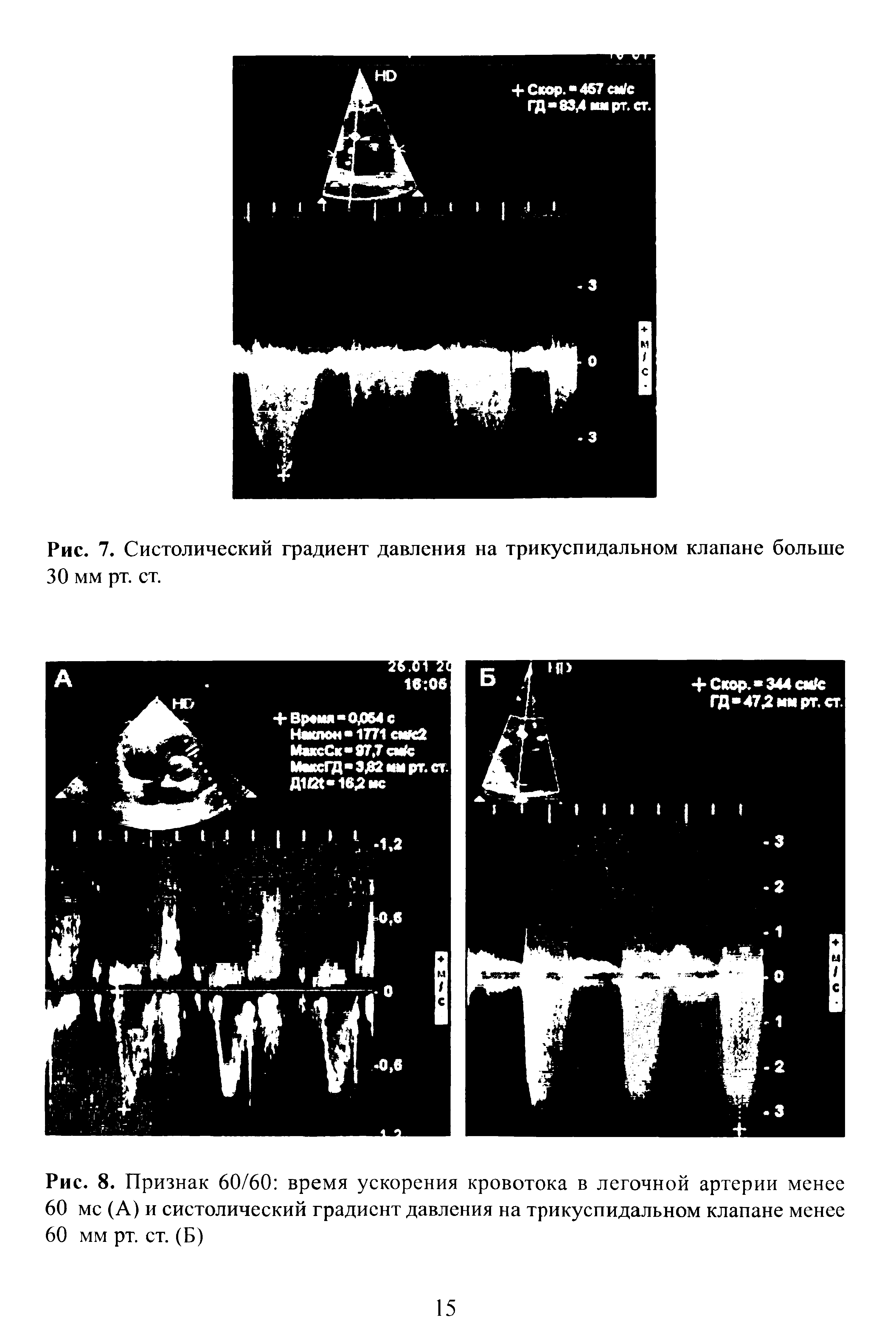 Рис. 8. Признак 60/60 время ускорения кровотока в легочной артерии менее...