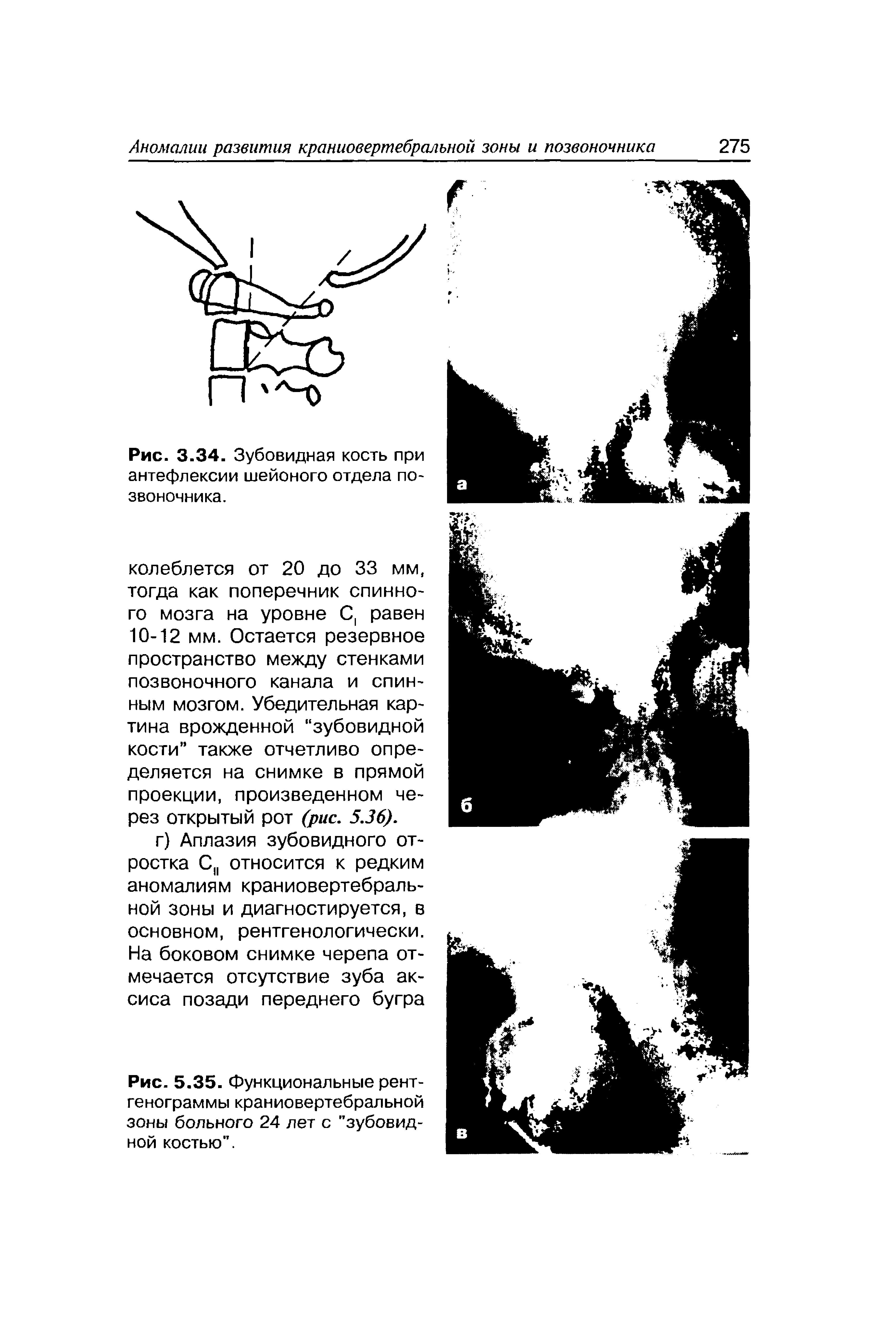 Рис. 5.35. Функциональные рентгенограммы краниовертебральной зоны больного 24 лет с "зубовидной костью".