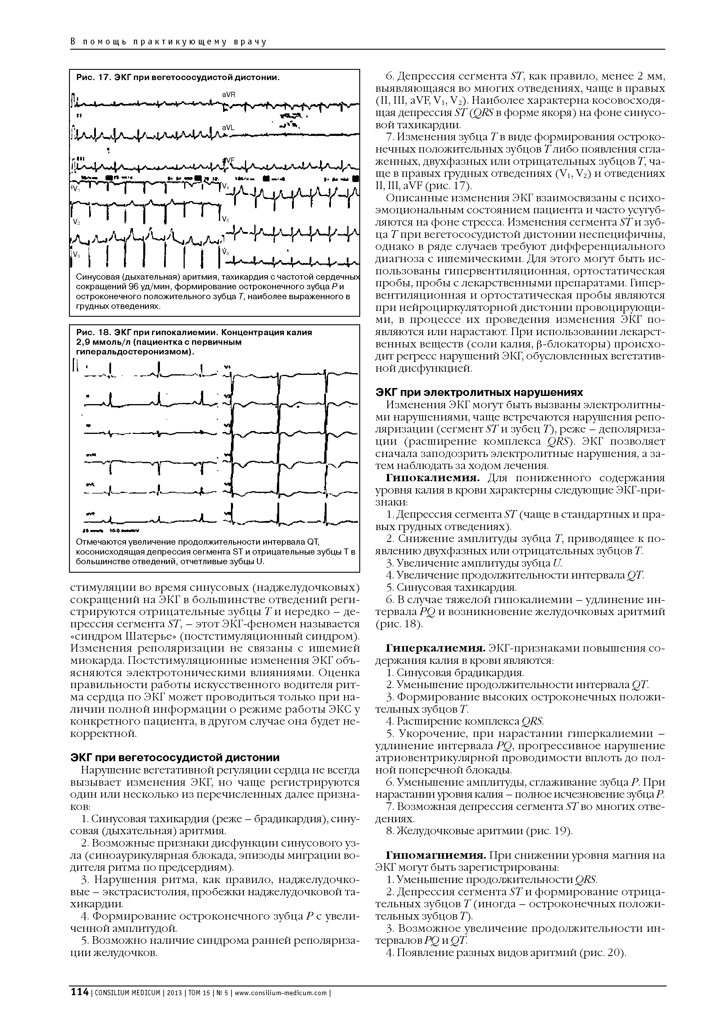 Рис. 18. ЭКГ при гипокалиемии. Концентрация калия 2,9 ммоль/л (пациентка с первичным гиперальдостеронизмом).