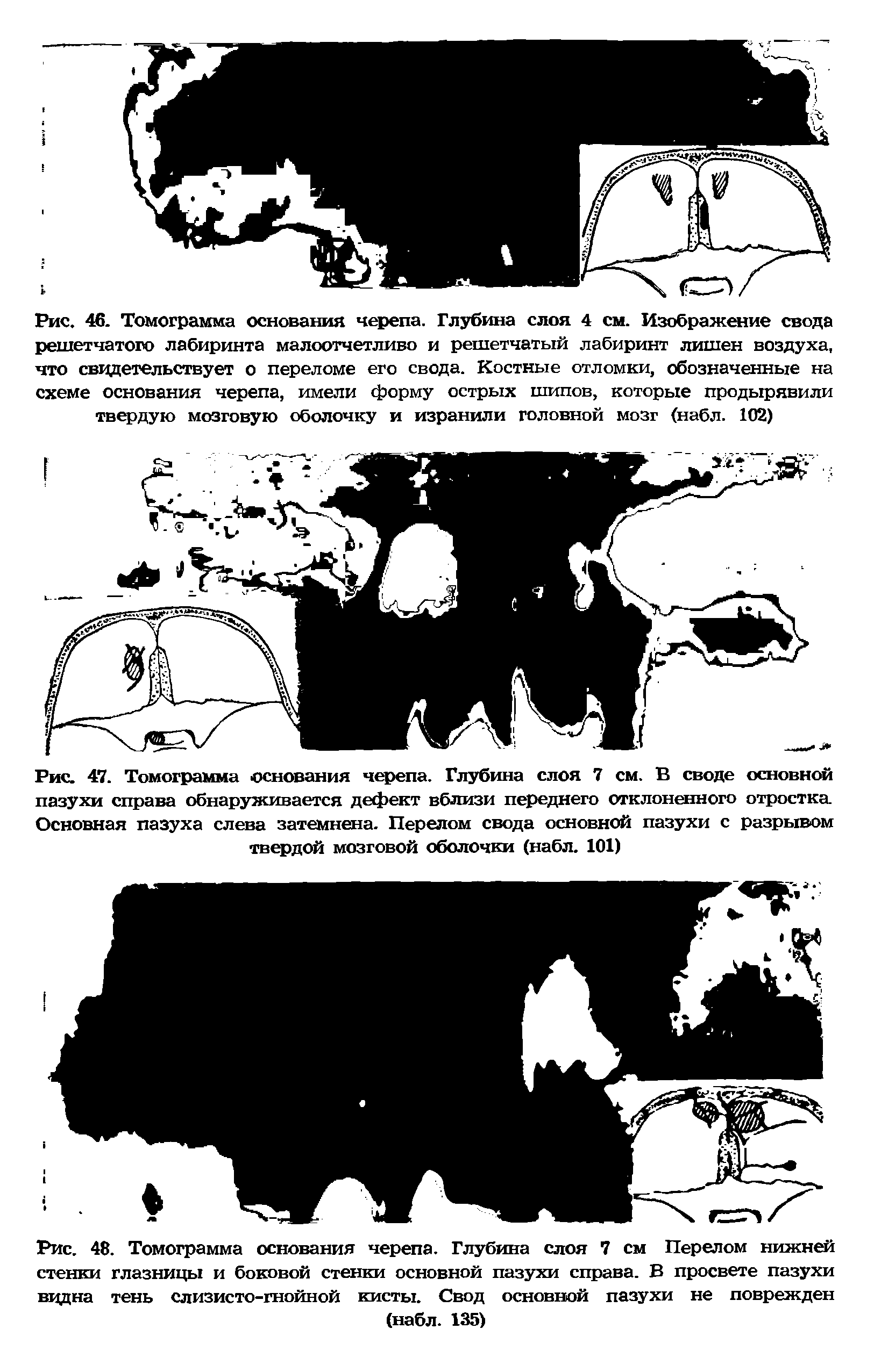 Рис. 48. Томограмма основания черепа. Глубина слоя 7 см Перелом нижней стенки глазницы и боковой стенки основной пазухи справа. В просвете пазухи ведна тень слизисто-гнойной кисты. Свод основной пазухи не поврежден (набл. 135)...