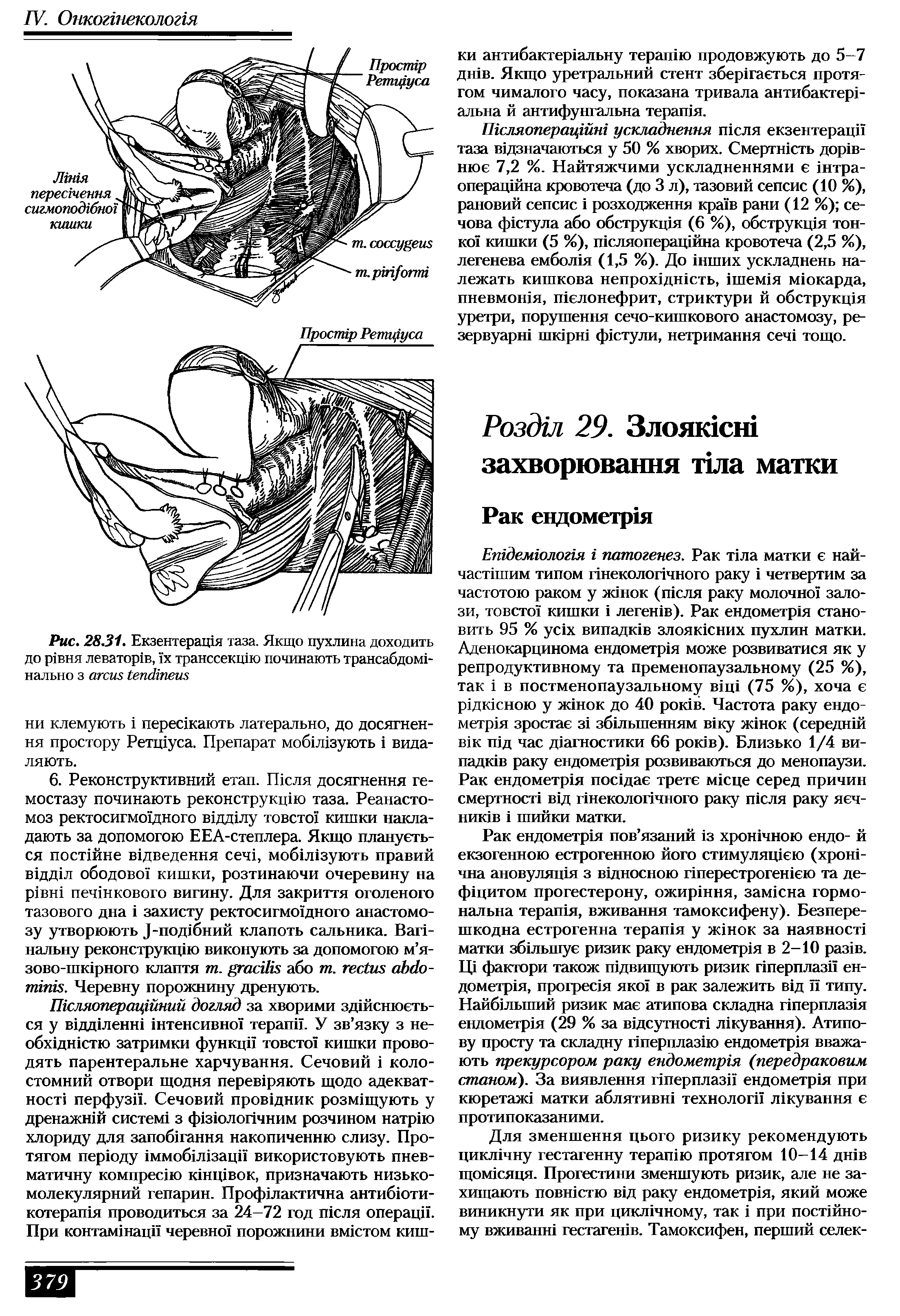 Рис. 28.31. Екзентеращя таза. Якщо пухлина доходить до , ня леватор1в, х транссекшю починають трансабдомн нально з ...