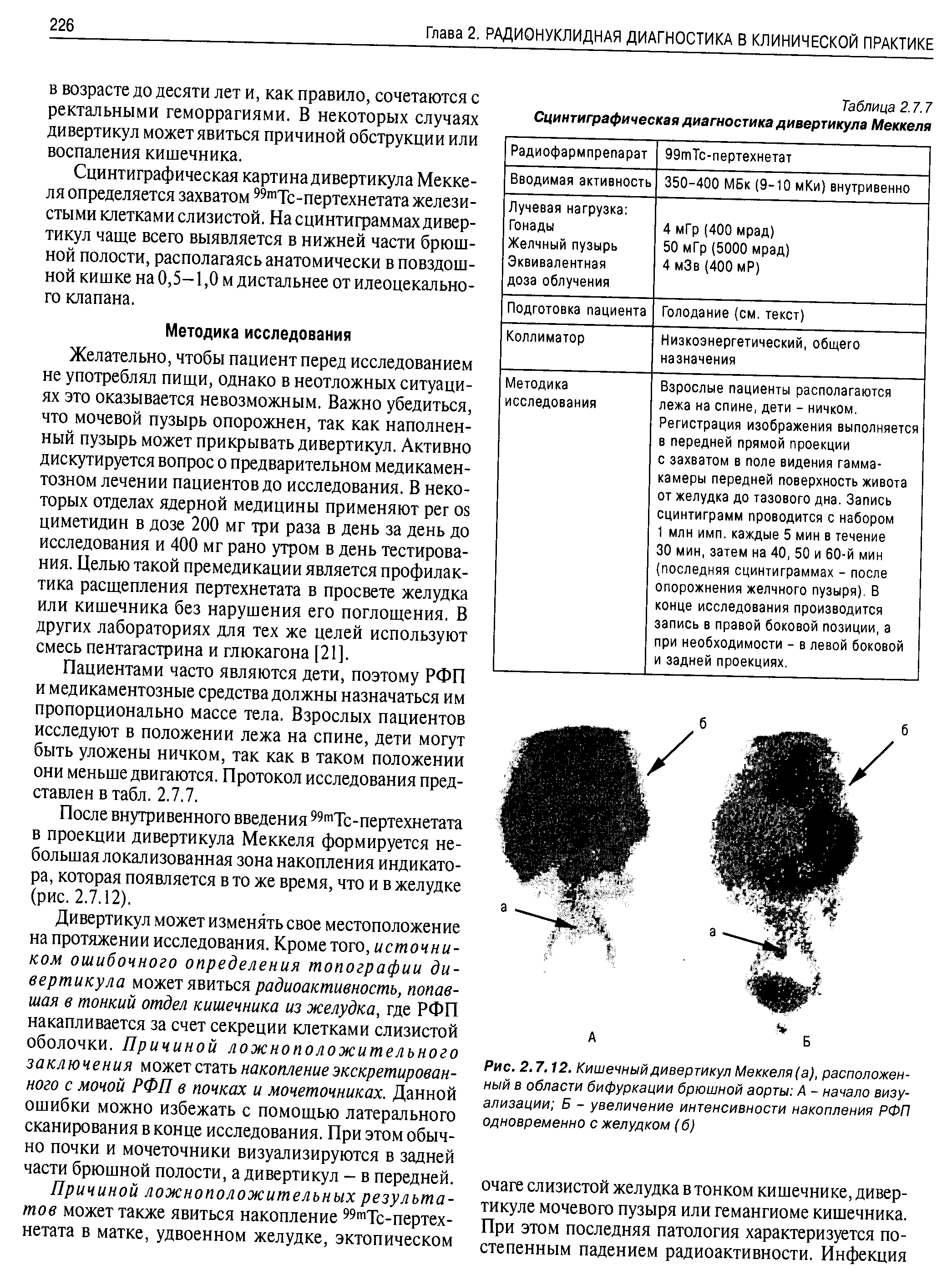 Рис. 2.7.12. Кишечный дивертикул Меккеля(а), расположенный в области бифуркации брюшной аорты А - начало визуализации Б - увеличение интенсивности накопления РФП одновременно с желудком (б)...