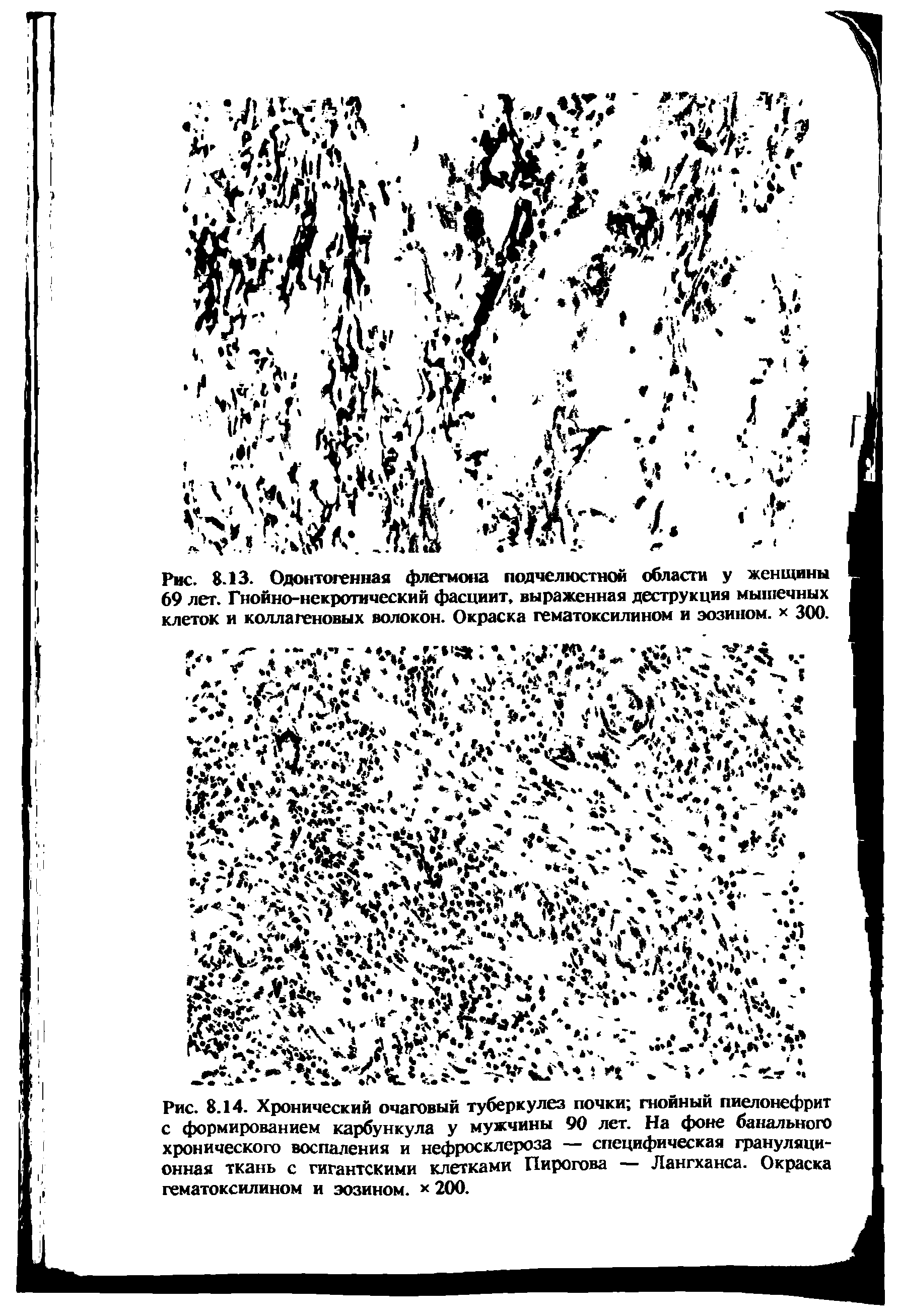Рис. 8.14. Хронический очаговый туберкулез почки гнойный пиелонефрит с формированием карбункула у мужчины 90 лет. На фоне банального хронического воспаления и нефросклероза — специфическая грануляционная ткань с гигантскими клетками Пирогова — Лангханса. Окраска гематоксилином и эозином. х 200.