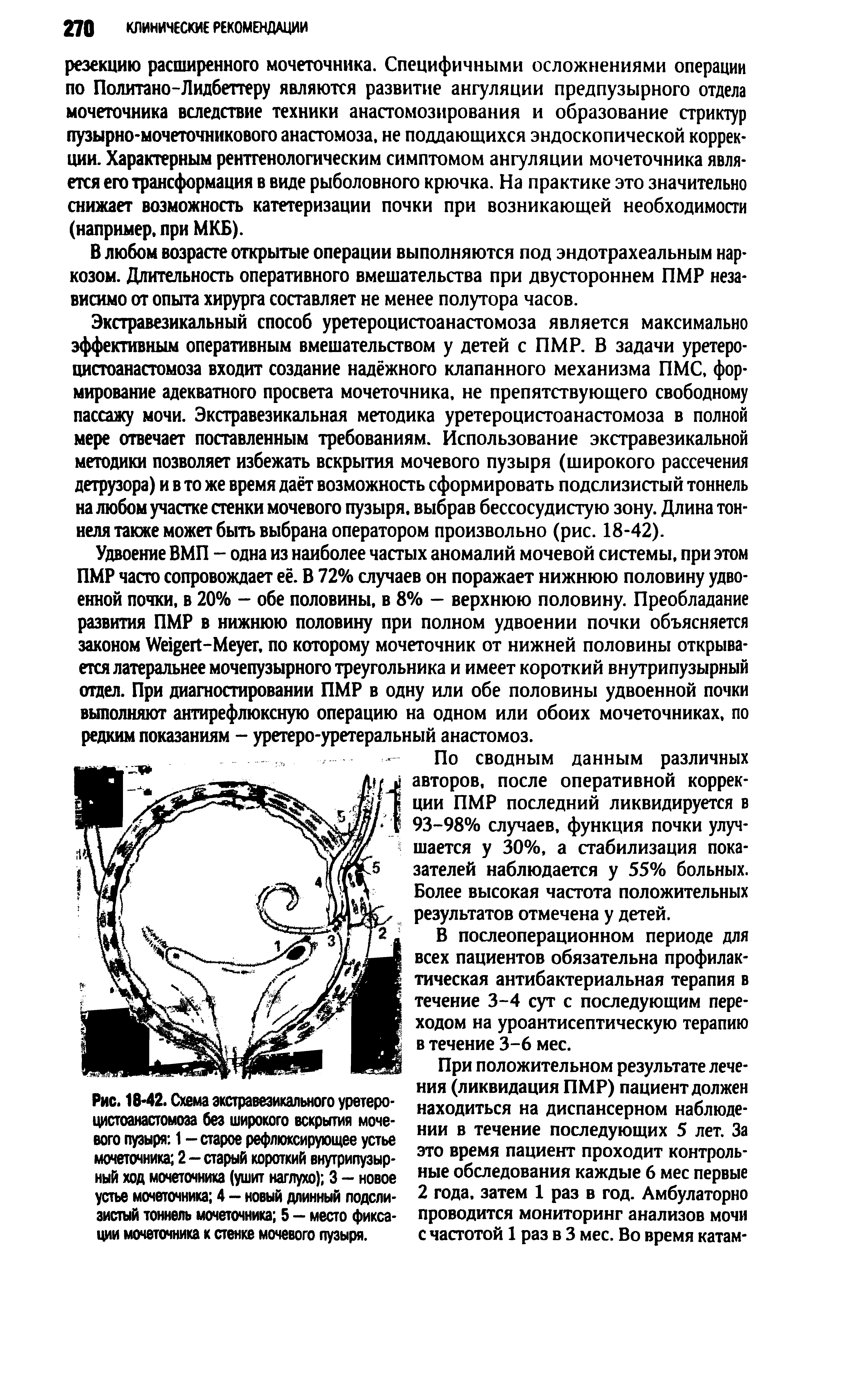 Рис. 16-42. Схема экстравезикального уретероцистоанастомоза без широкого вскрытия мочевого пузыря 1 - старое рефлексирующее устье мочеточника 2 - старый короткий внугрипузыр-ный ход мочеточника (ушит наглухо) 3 — новое устье мочеточника 4 - новый длинный подслизистый тоннель мочеточника 5 - место фиксации мочеточника к стенке мочевого пузыря.