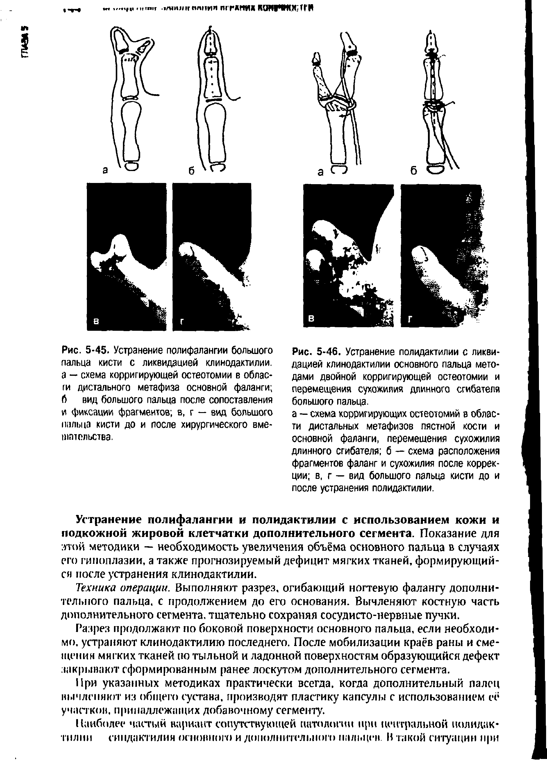 Рис. 5-45. Устранение полифалангии большого пальца кисти с ликвидацией клинодактилии. а — схема корригирующей остеотомии в области дистального метафиза основной фаланги 6 вид большого пальца после сопоставления и фиксации фрагментов в, г — вид большого пальца кисти до и после хирургического вме-щтельства.