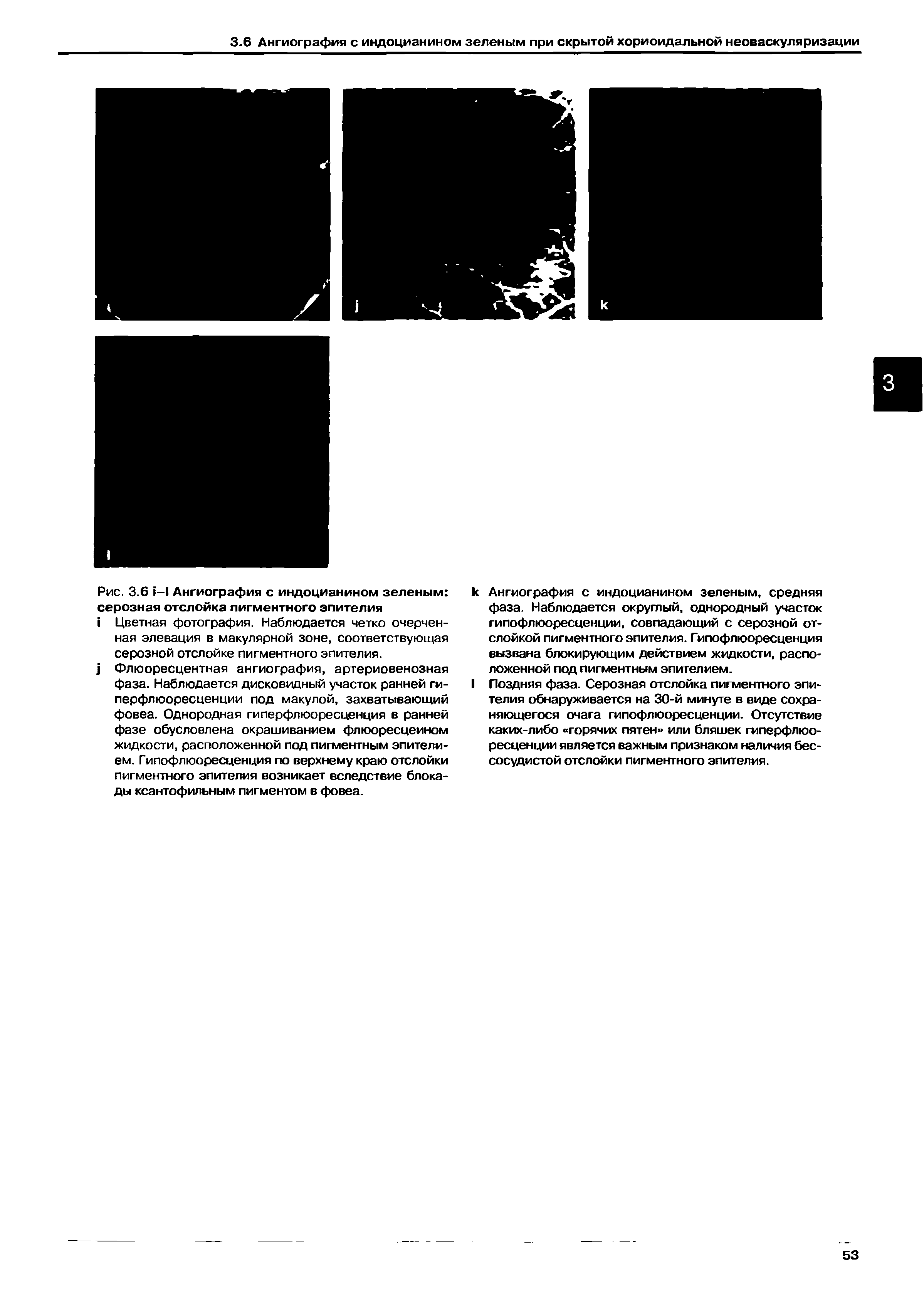 Рис. 3.6 -I Ангиография с индоцианином зеленым серозная отслойка пигментного эпителия...