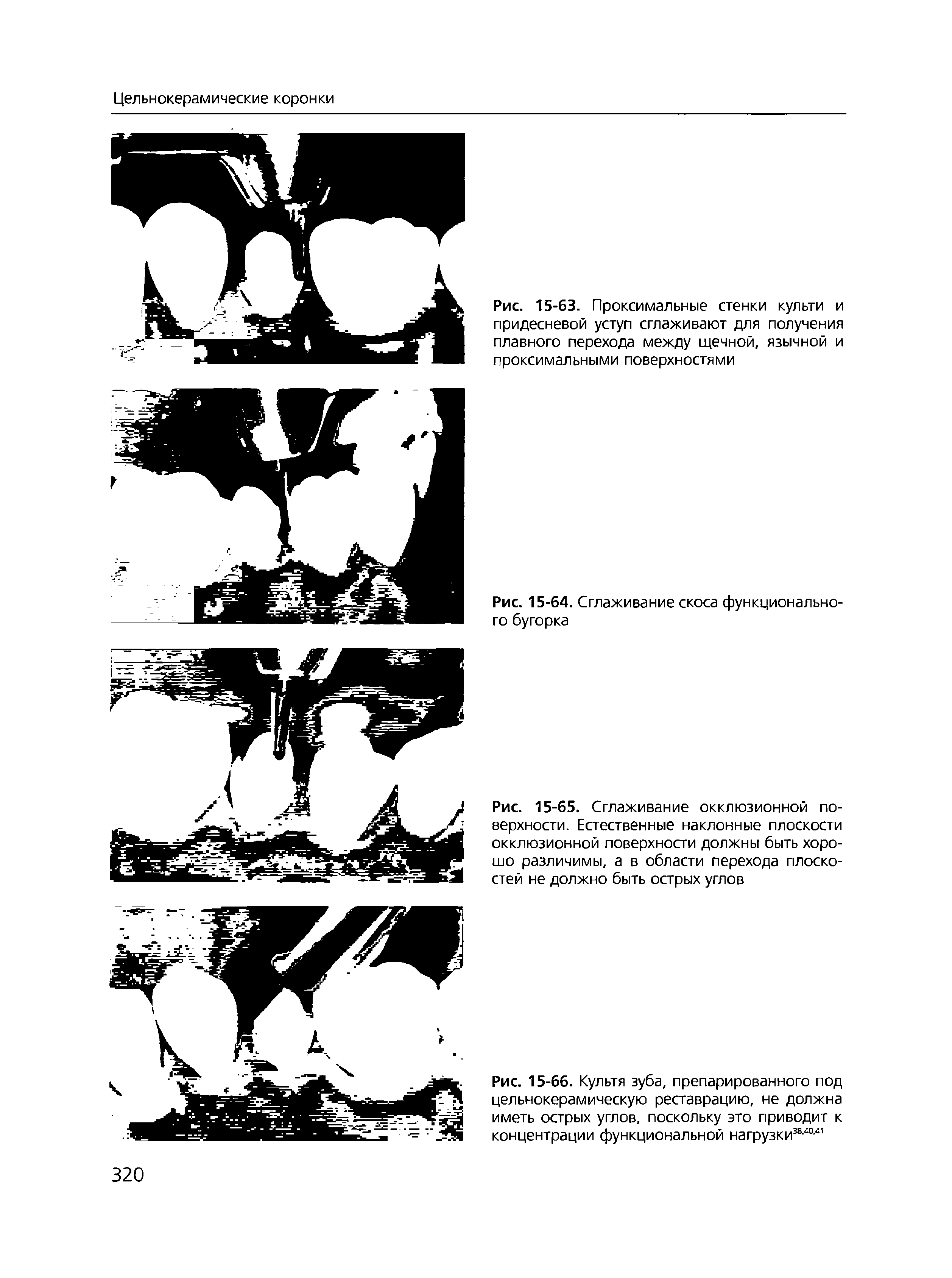Рис. 15-63. Проксимальные стенки культи и придесневой уступ сглаживают для получения плавного перехода между щечной, язычной и проксимальными поверхностями...