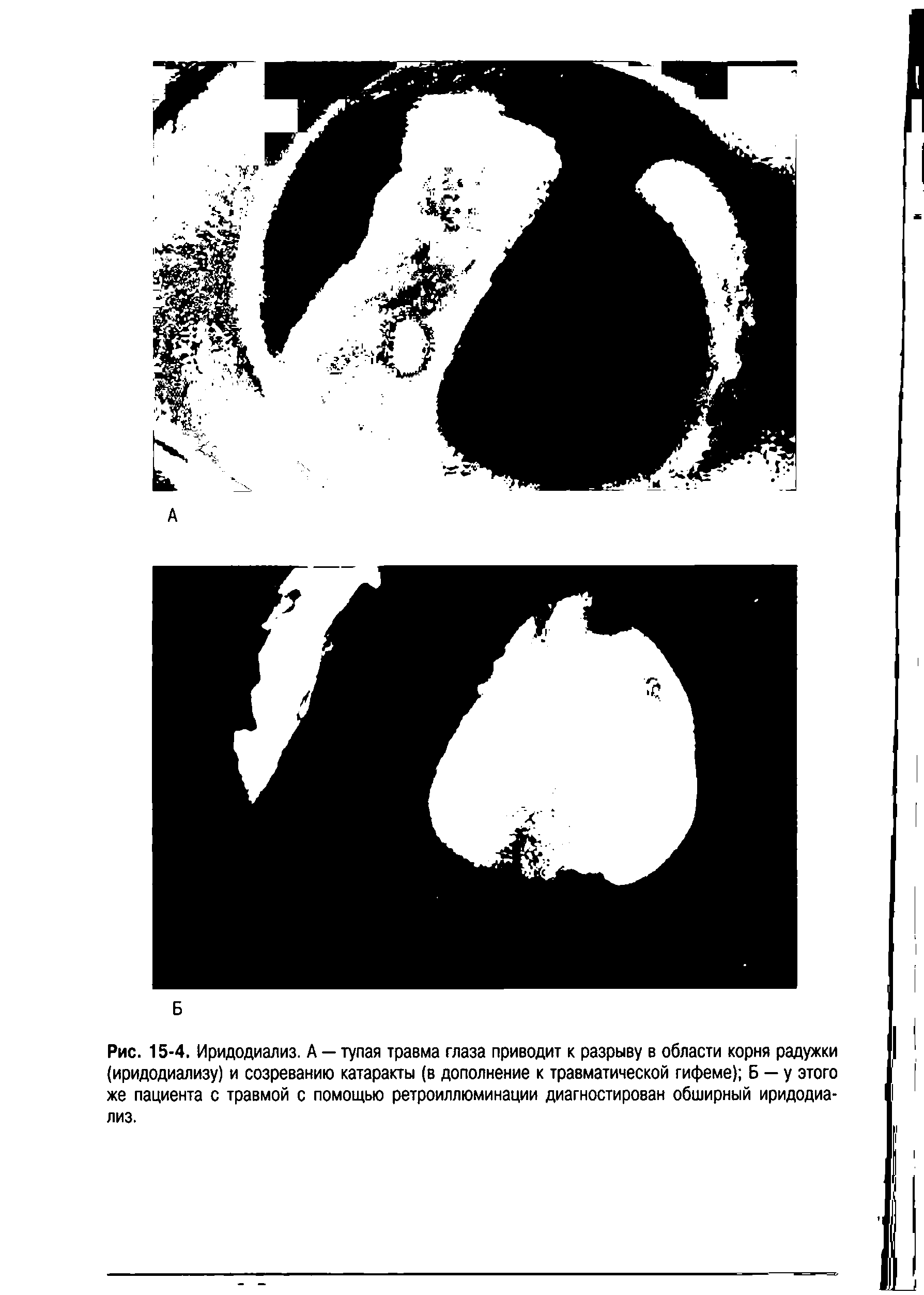 Рис. 15-4. Иридодиализ. А — тупая травма глаза приводит к разрыву в области корня радужки (иридодиализу) и созреванию катаракты (в дополнение к травматической гифеме) Б — у этого же пациента с травмой с помощью ретроиллюминации диагностирован обширный иридодиализ.